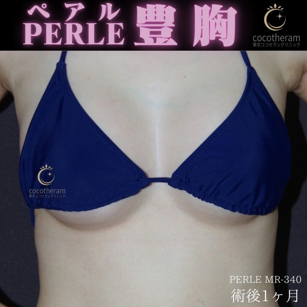 シリコン豊胸（PERLE-MR340）＋脇肉 No27