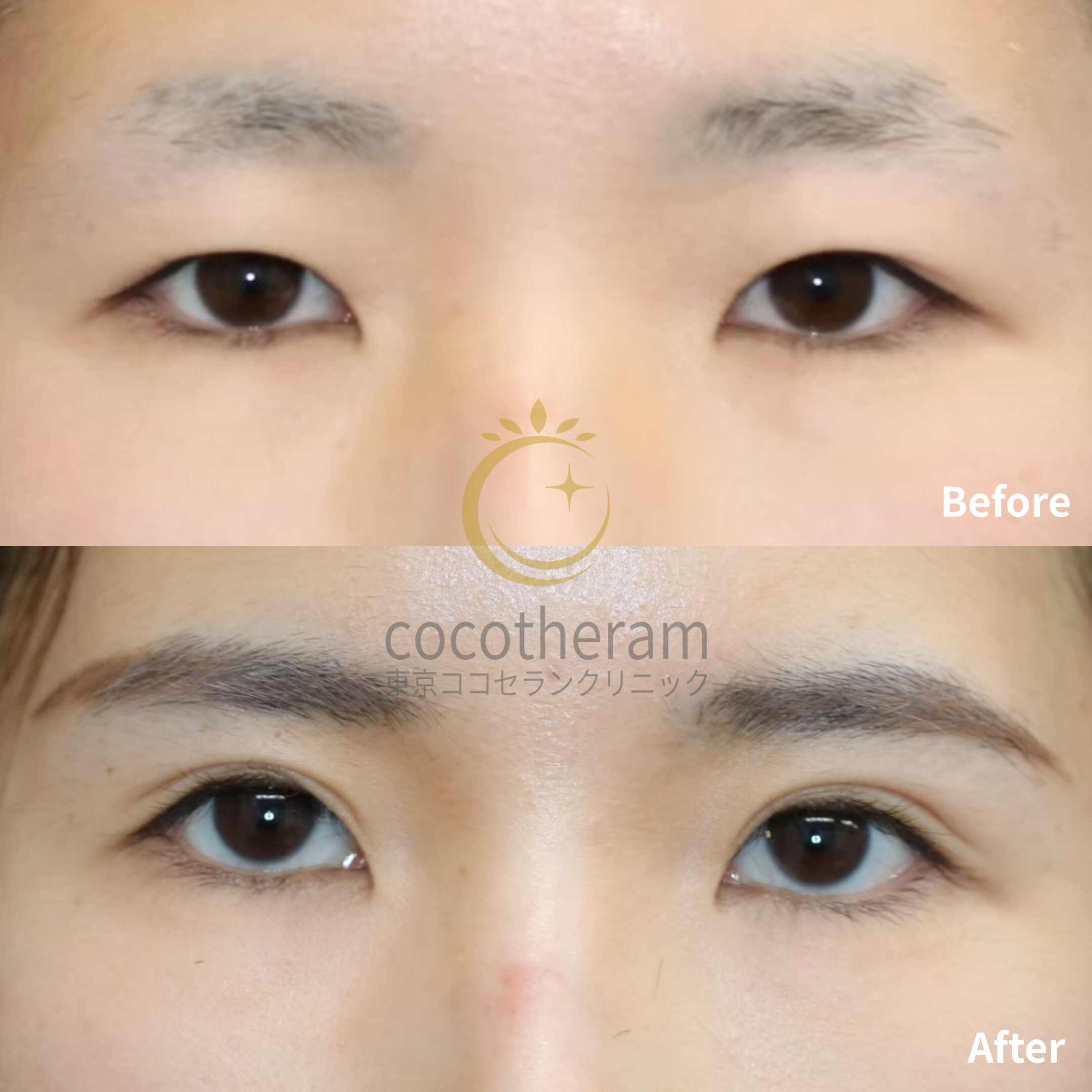 二重切開法 / 二重埋没抜糸法