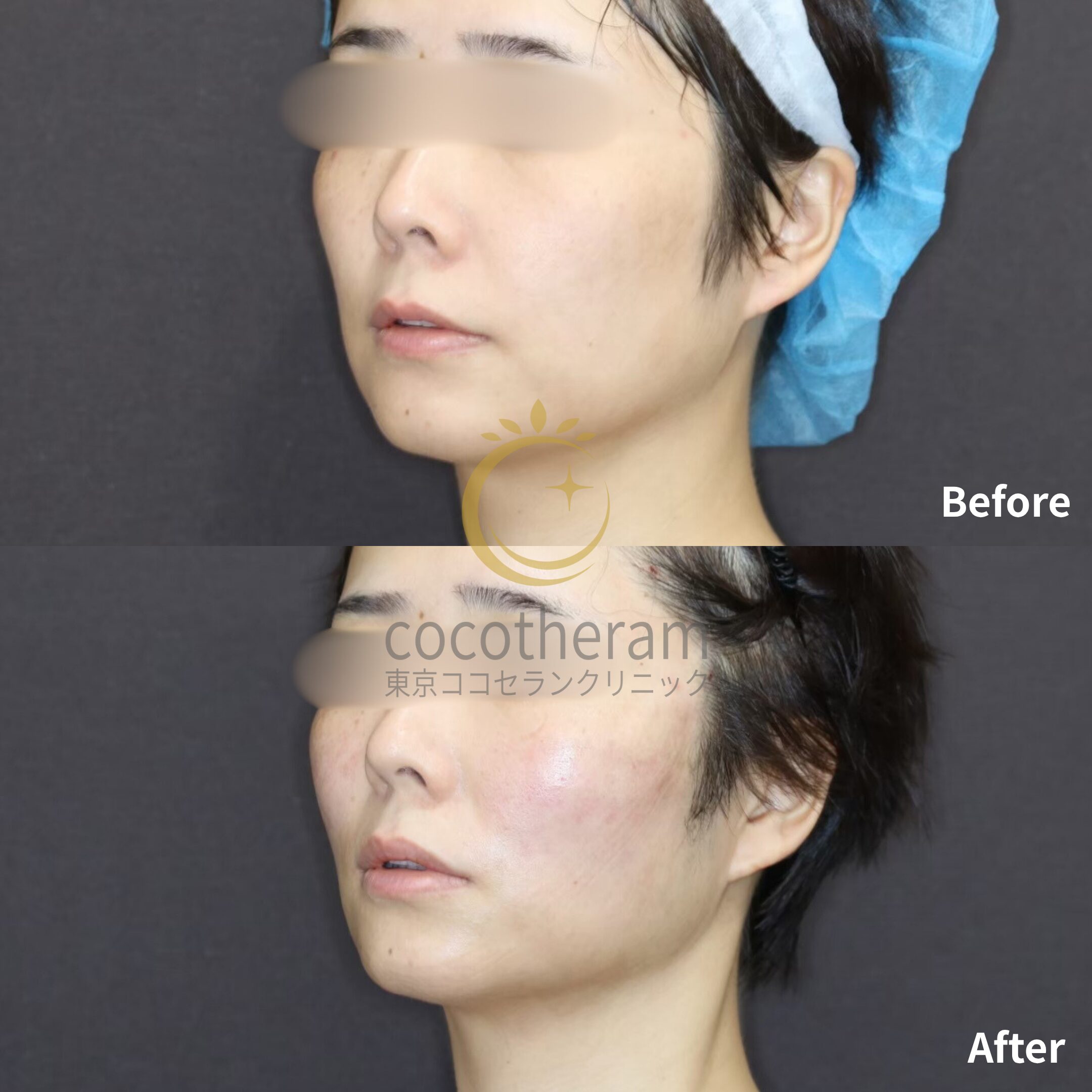 スレッドリフト