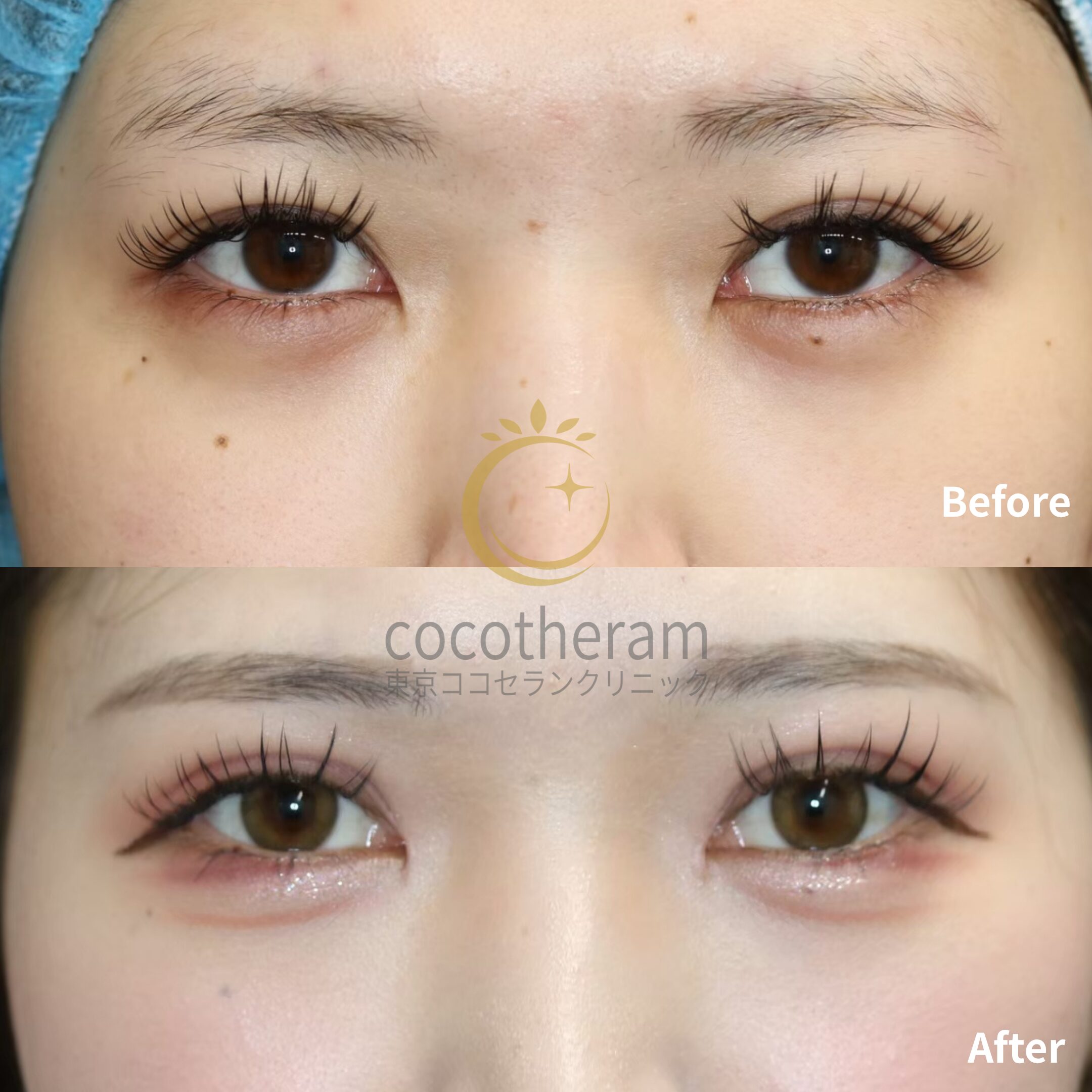 二重埋没法3点留め / 目頭切開