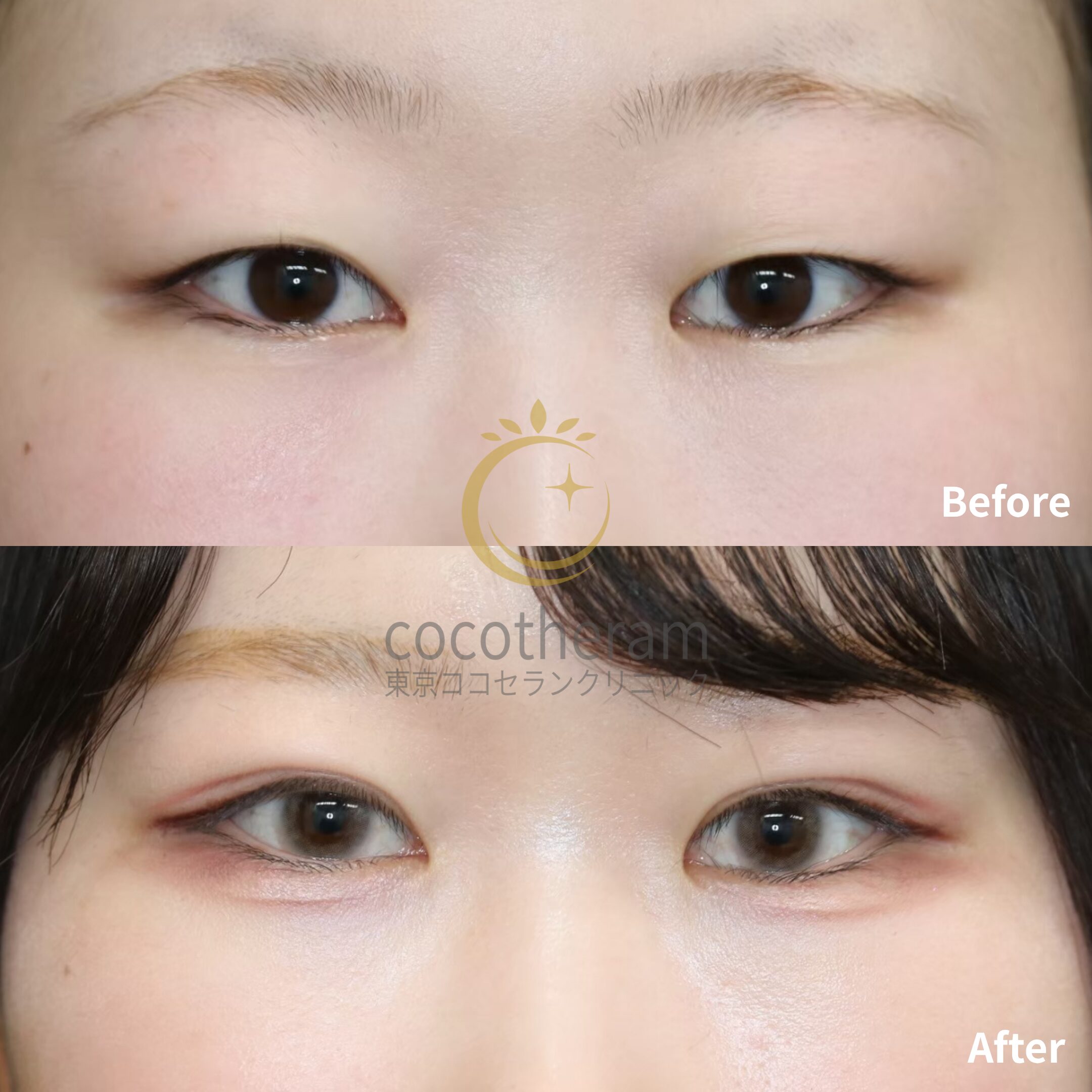 二重埋没法6点留め