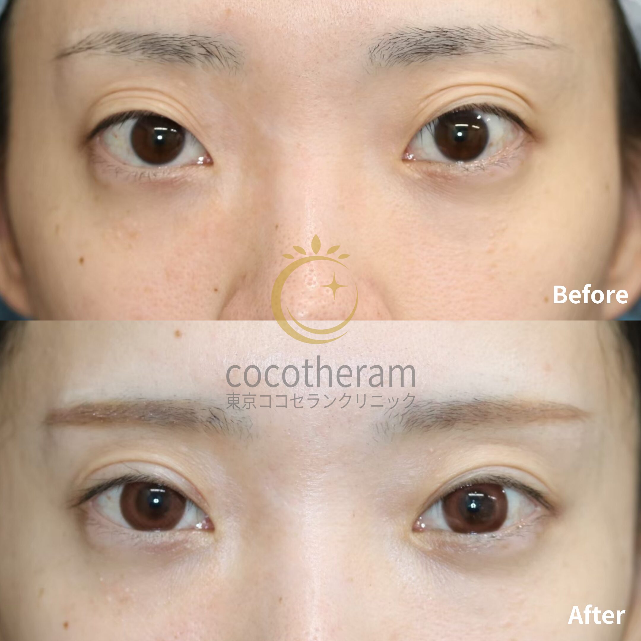 眼瞼下垂症手術 / 二重埋没抜糸法