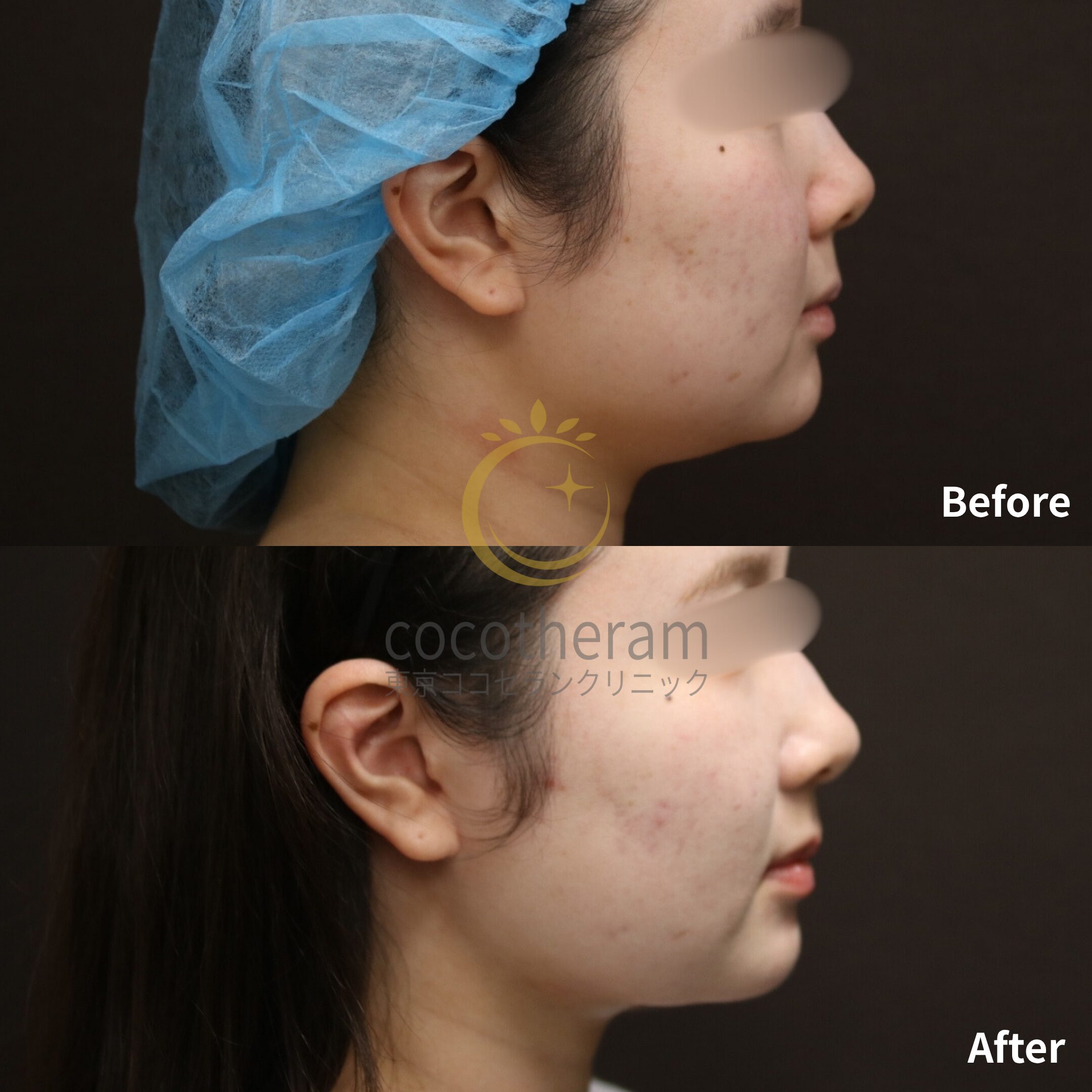 小顔マジック / ボトックス注射