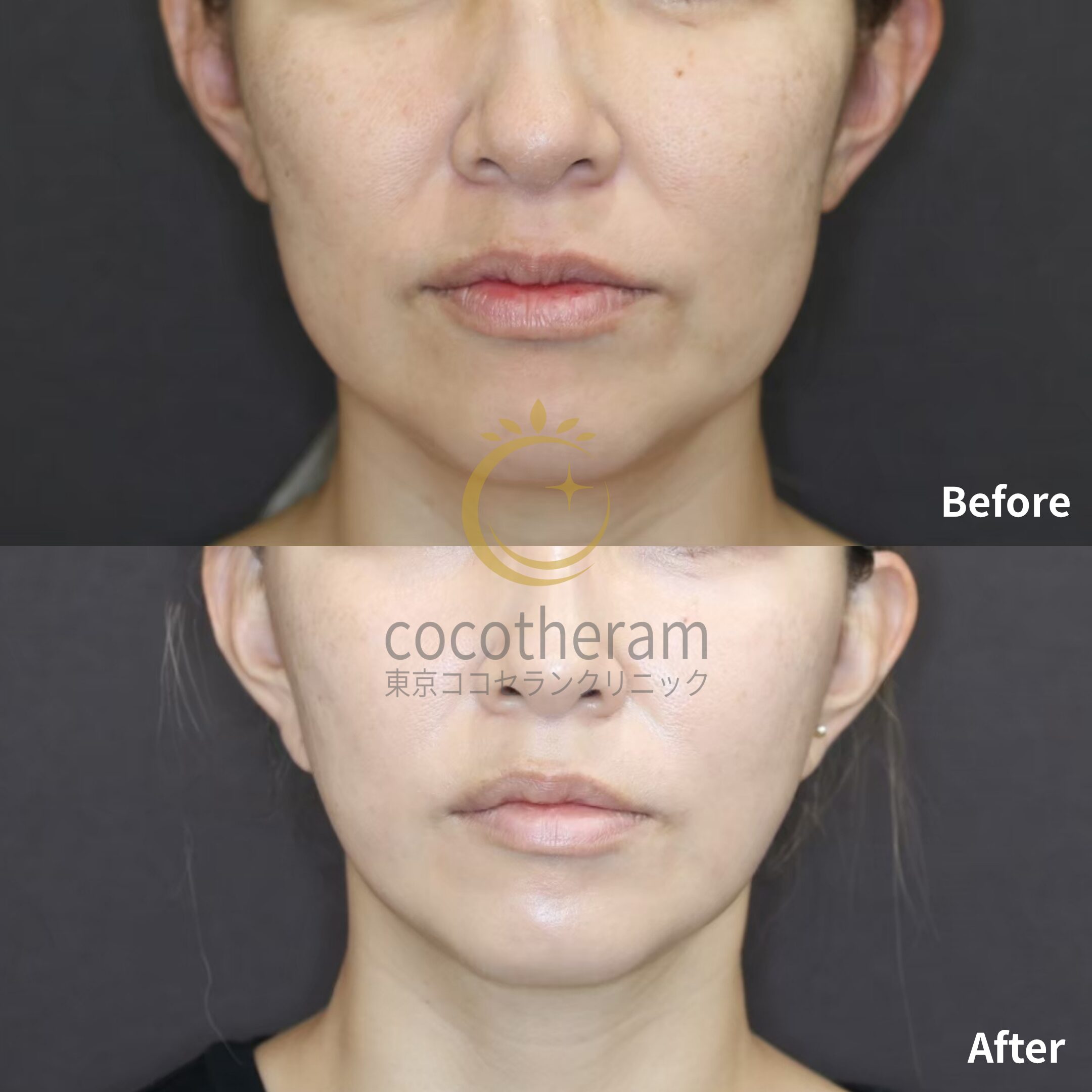 トータルフェイスリフト / 脂肪吸引 / ボトックス注射