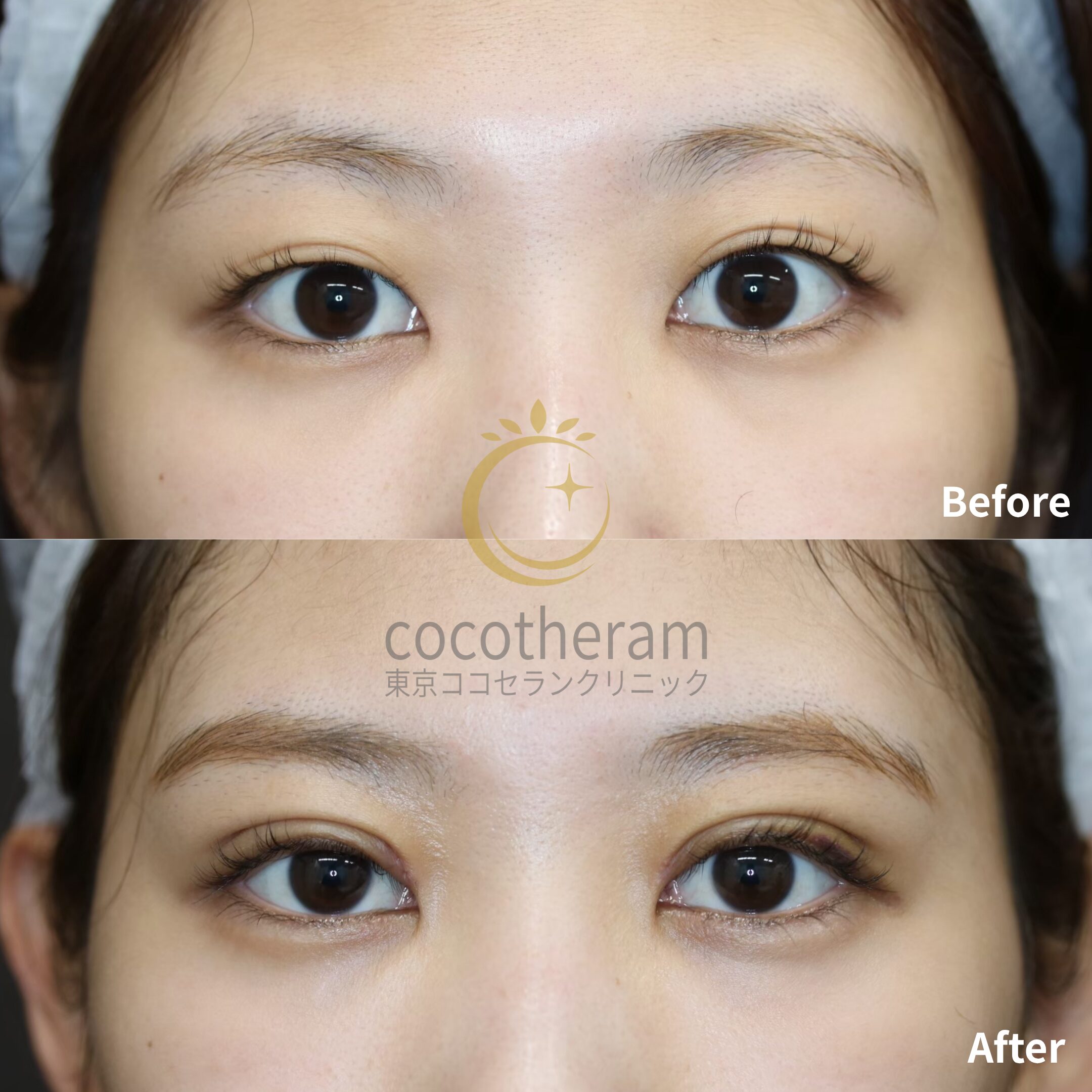 二重埋没法3点留め / 目頭切開