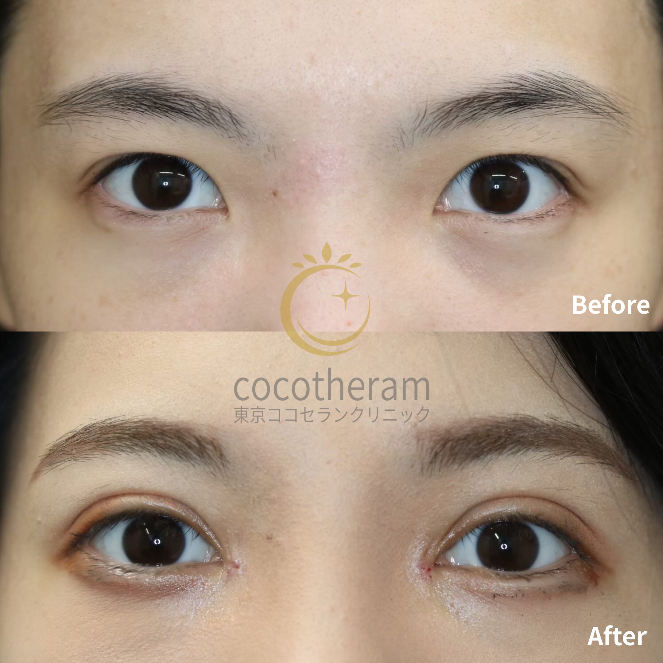 二重埋没法2点留め / 目頭切開