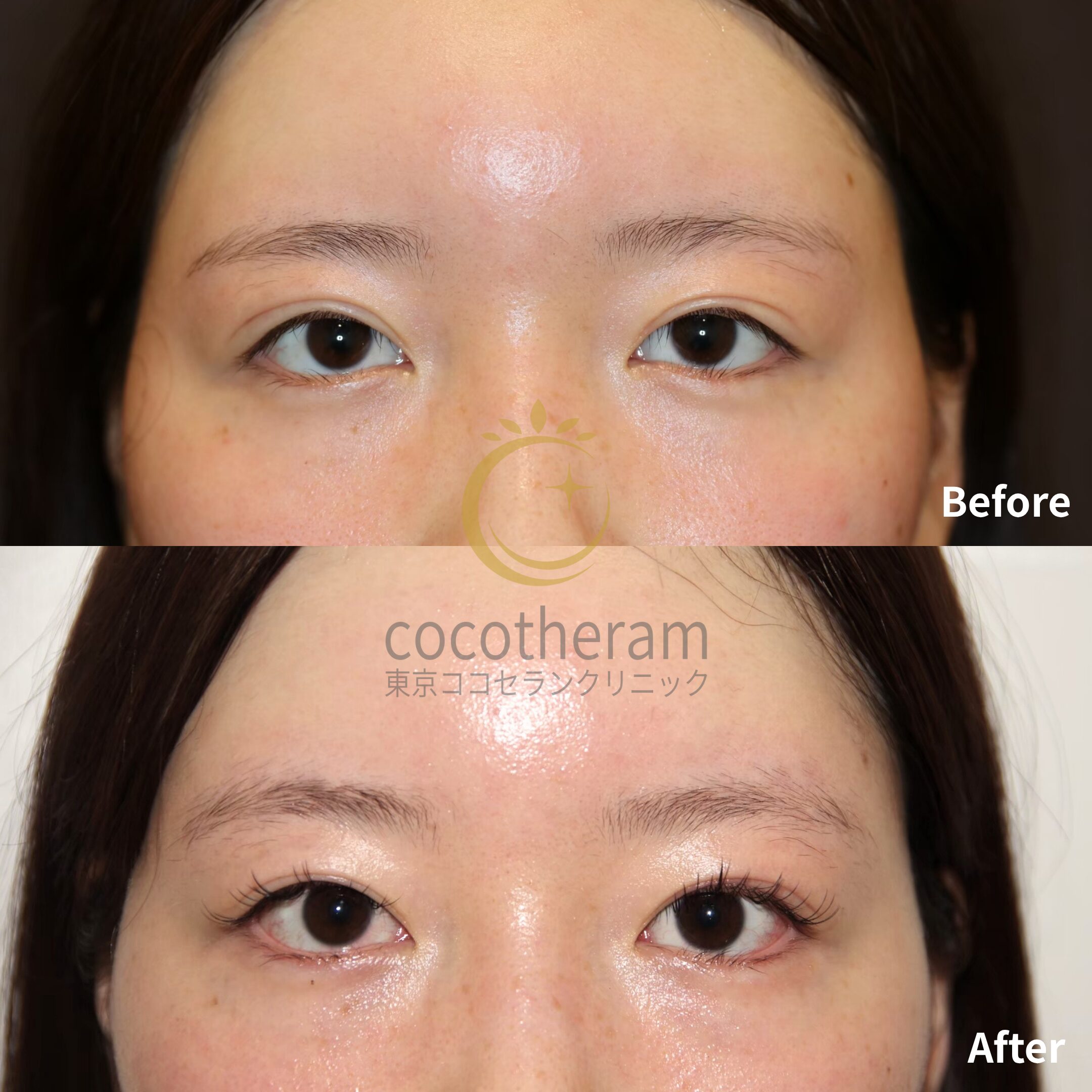 眼瞼下垂症手術