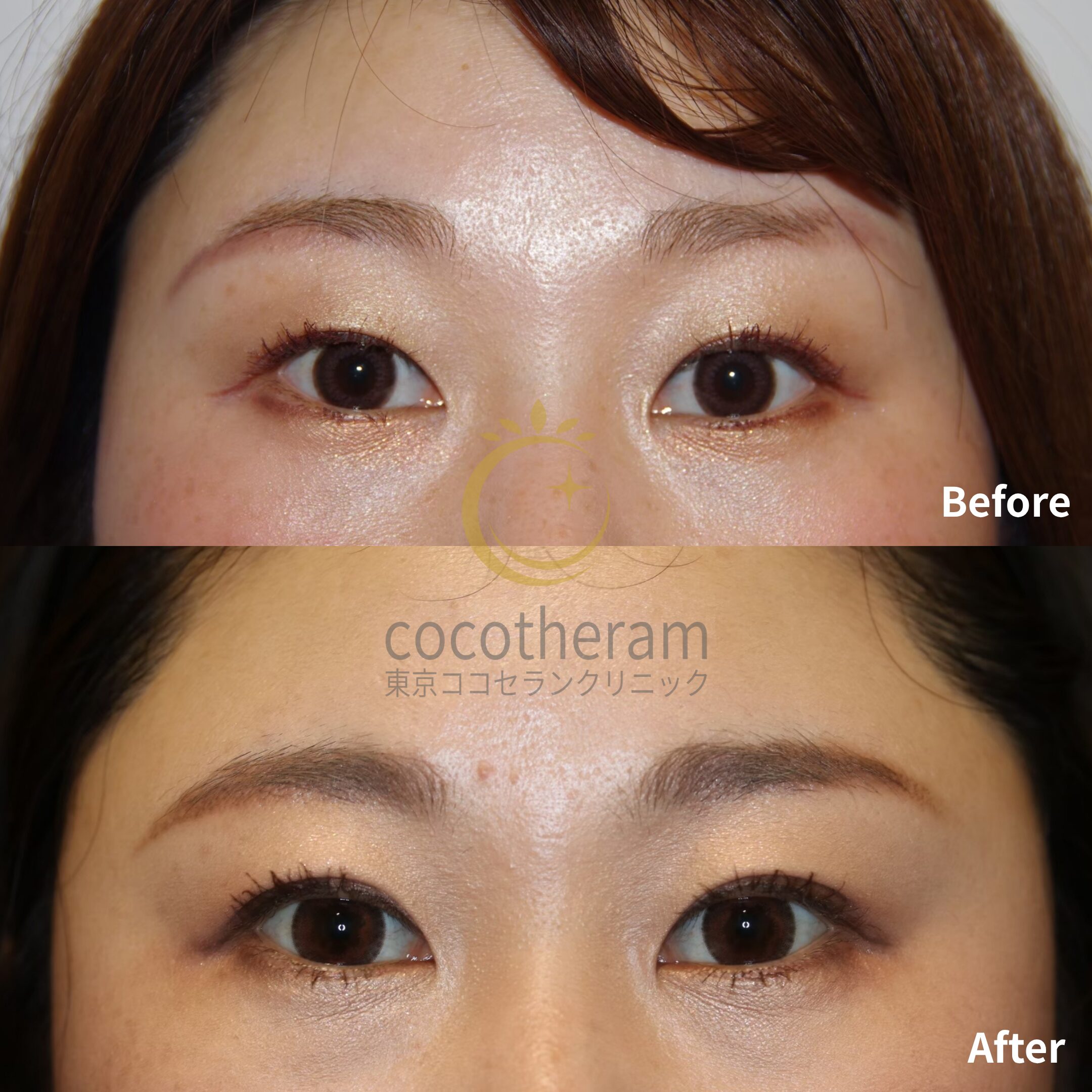 二重埋没法3点留め