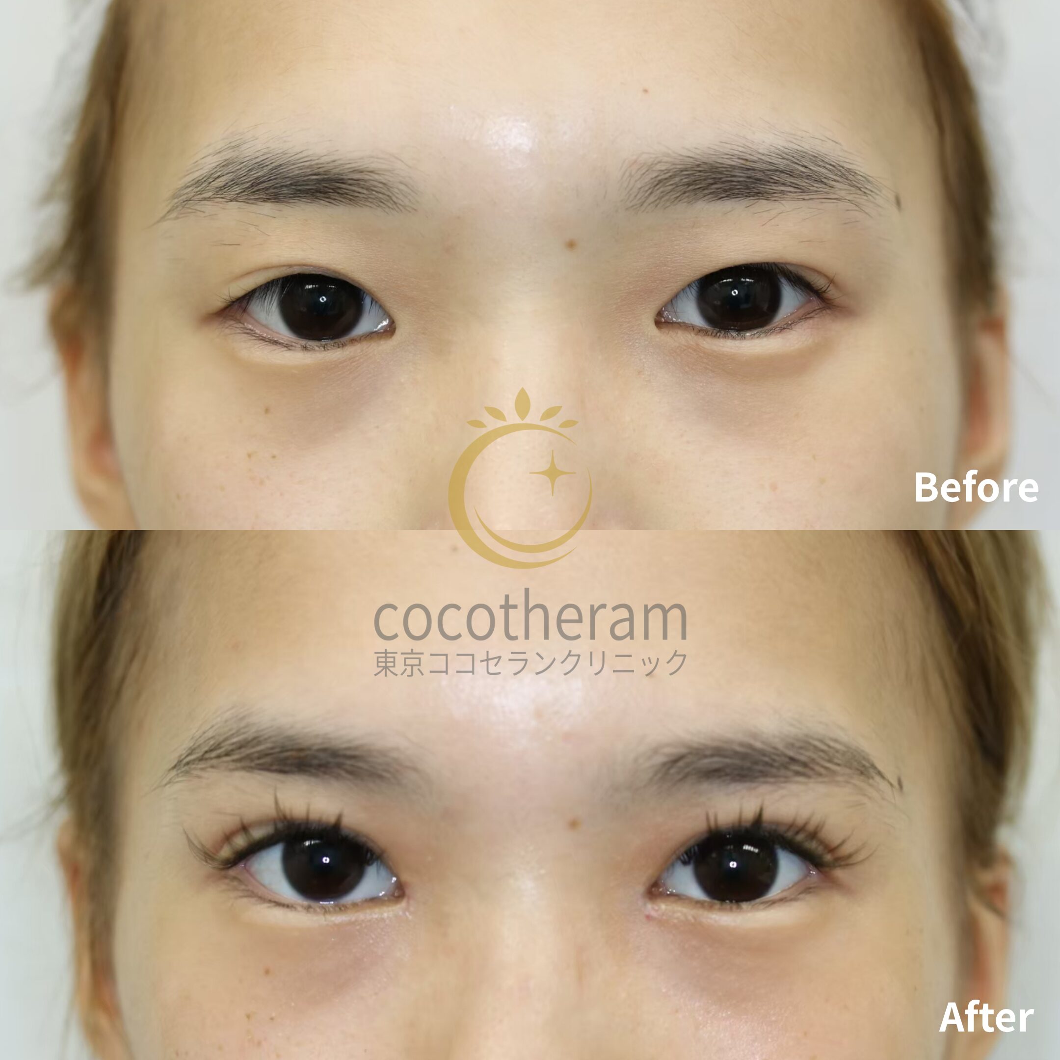 二重埋没法2点留め / 目頭切開