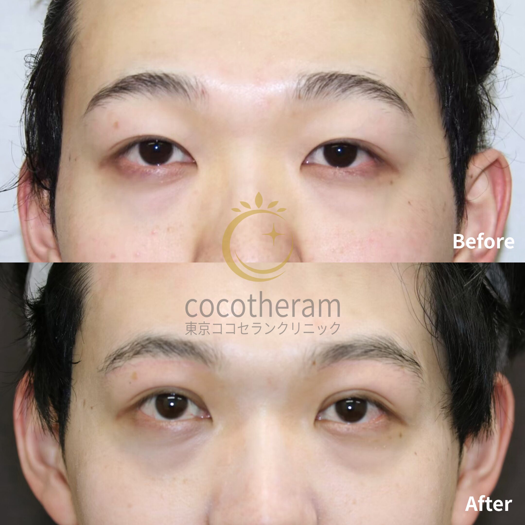 眉下切開 / 二重埋没法2点留め