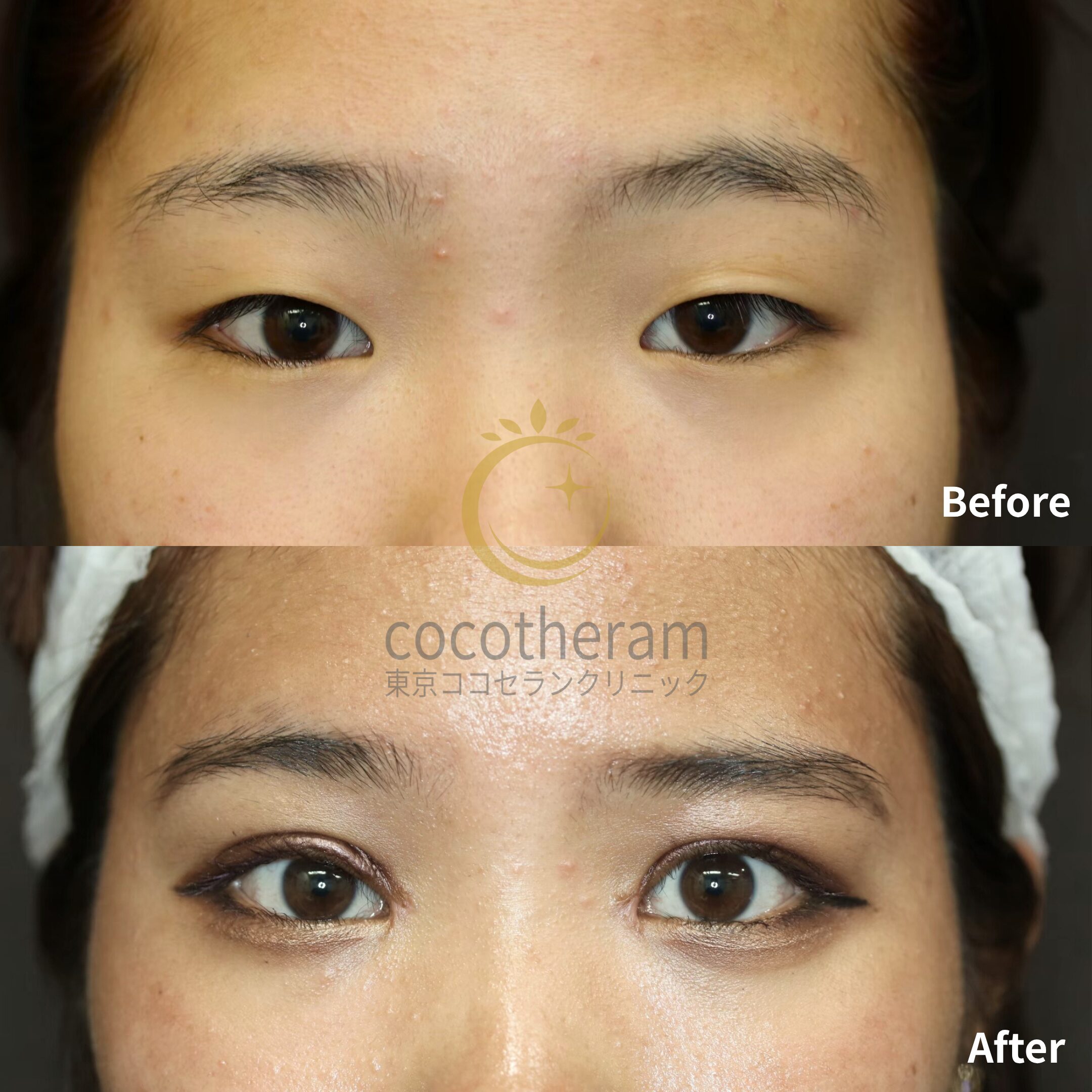 目頭切開 / 眼瞼下垂症手術 / 二重切開法