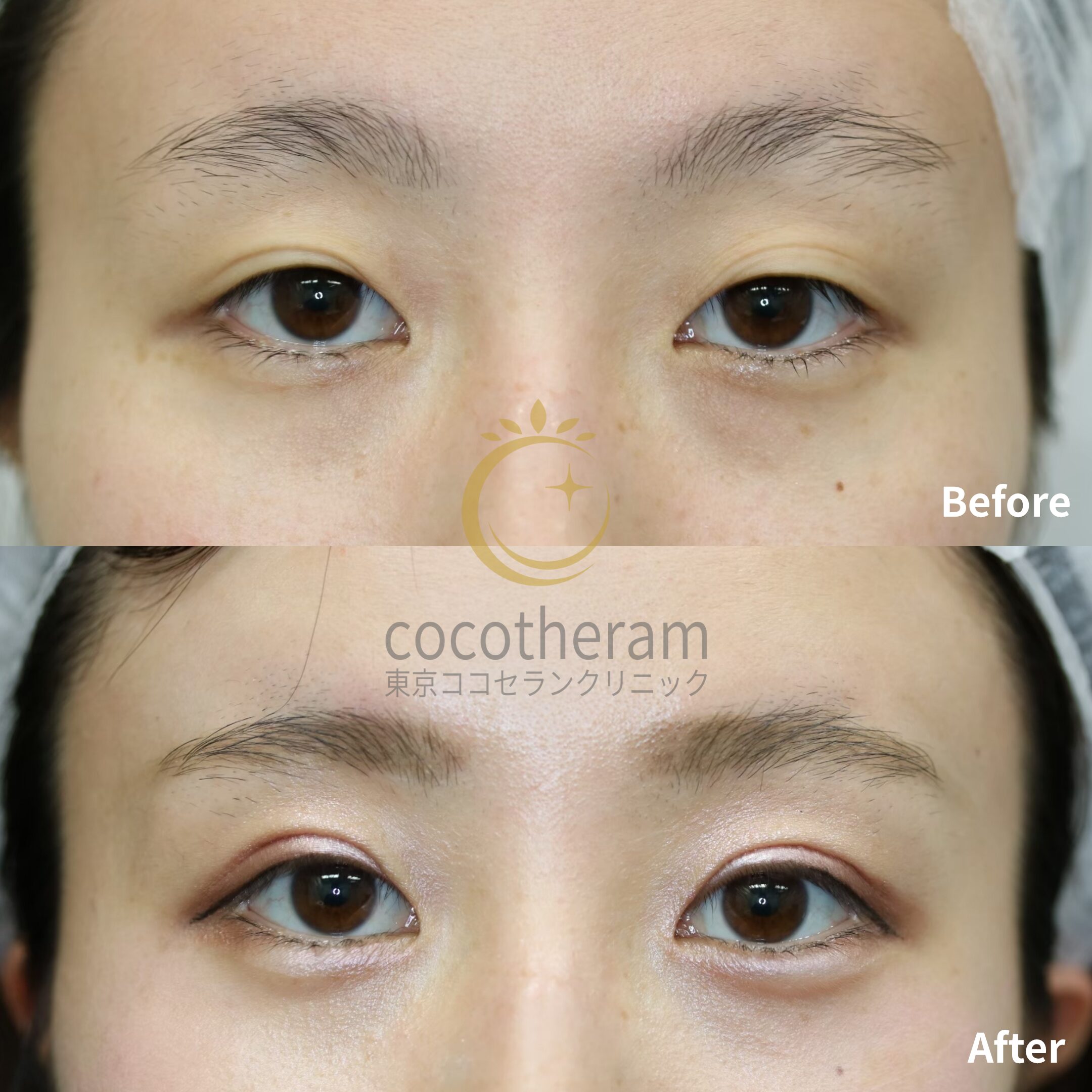 二重切開法 / 二重埋没抜糸法