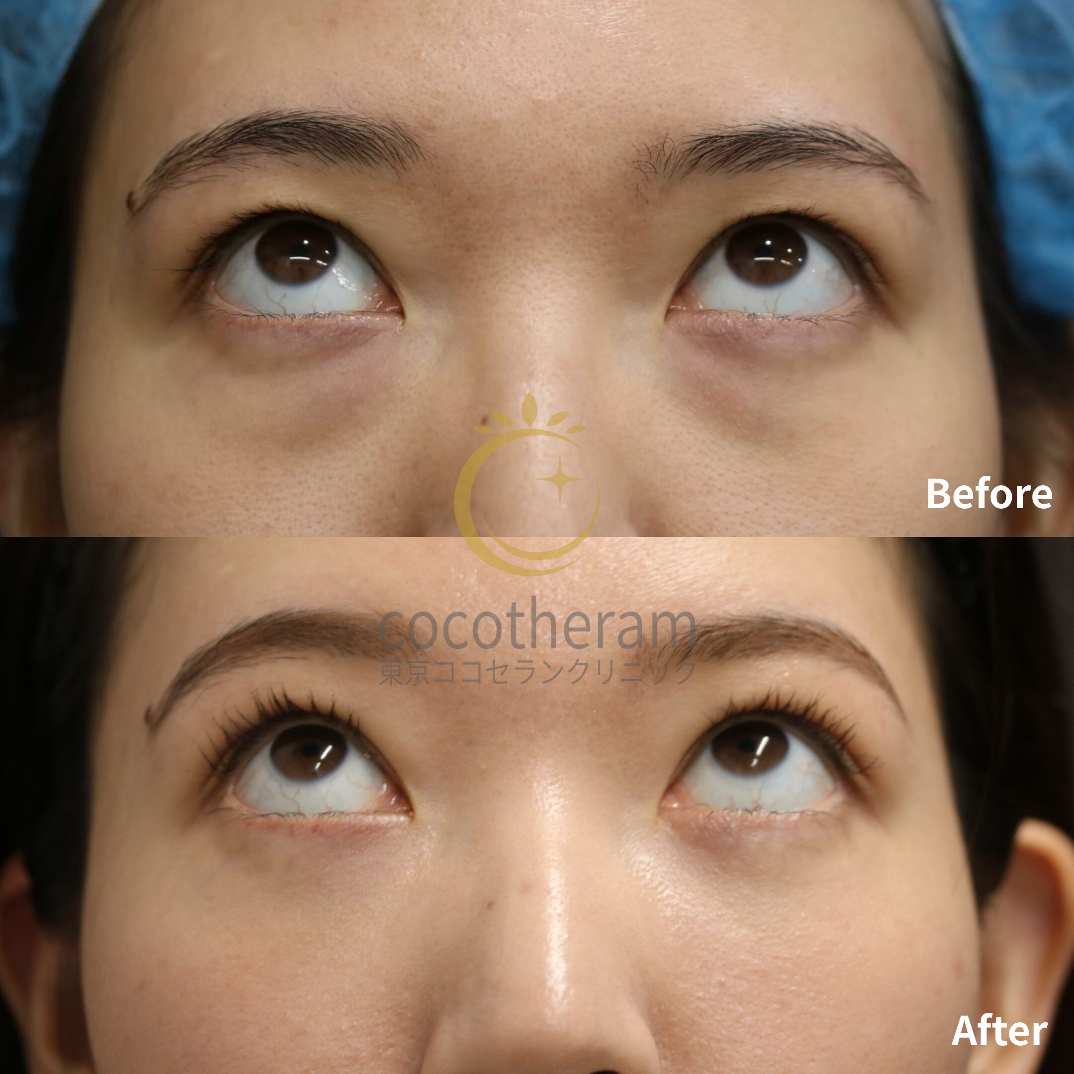 ミッドフェイスリフト