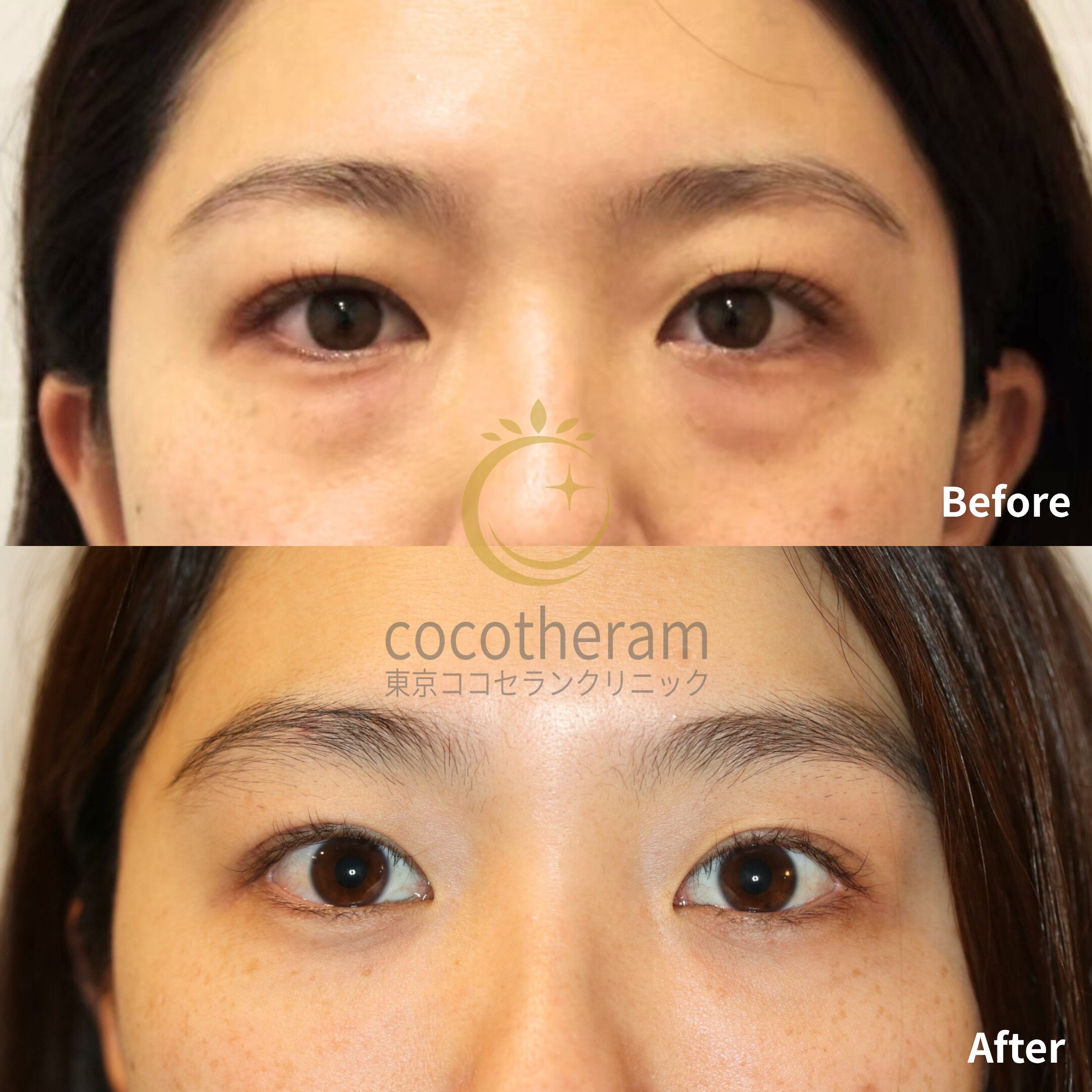 経結膜脱脂術 / 脂肪注入