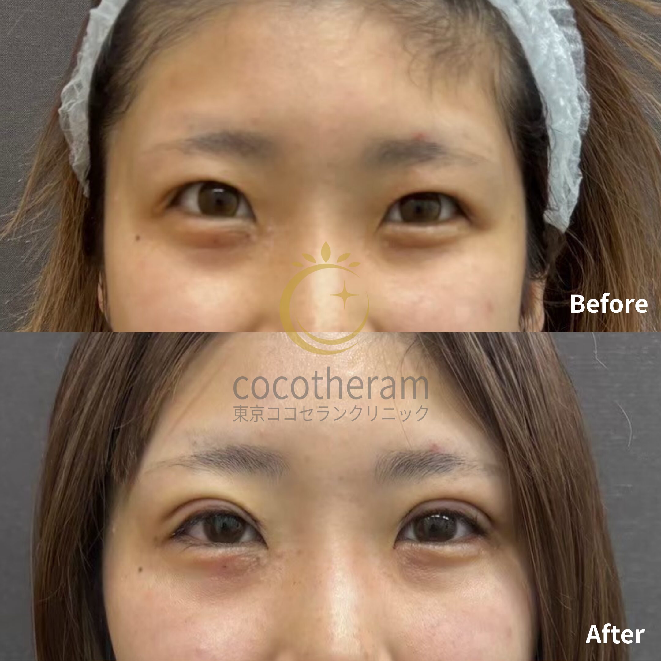 二重埋没法6点留め / 目の上切開