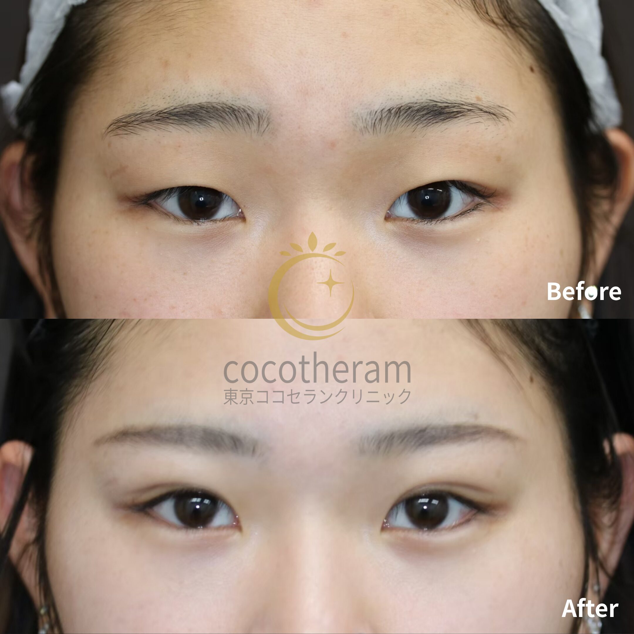 二重埋没法3点留め