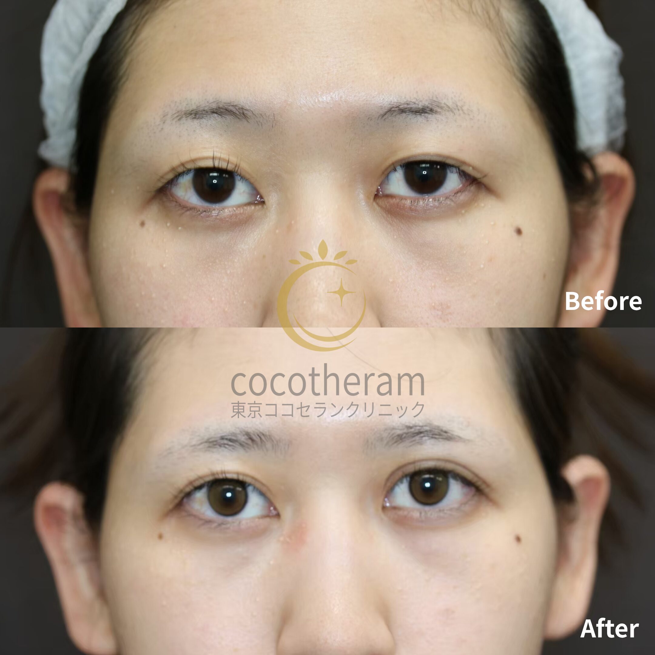 二重切開法 / 二重埋没抜糸法