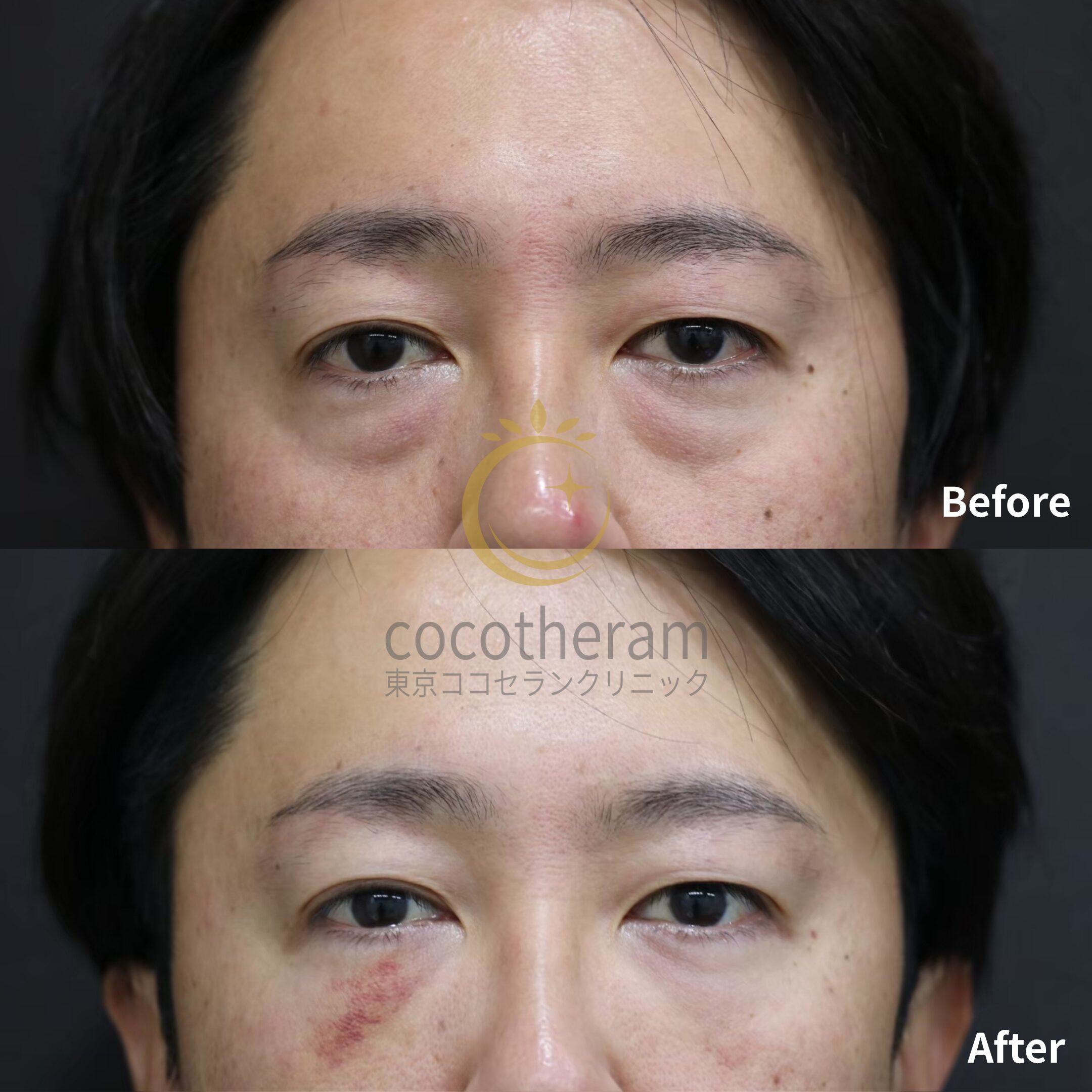 経結膜脱脂術 / 脂肪注入