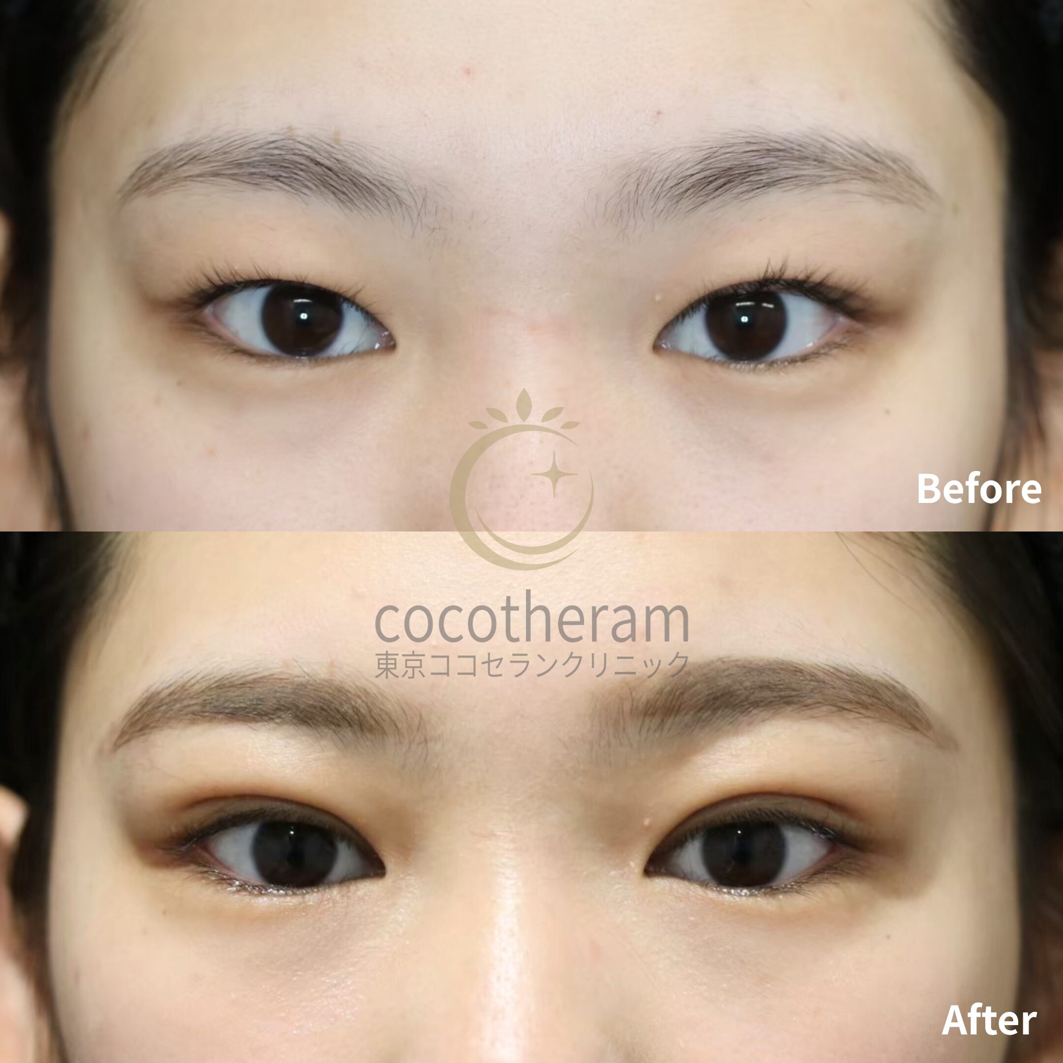 二重埋没法3点留め