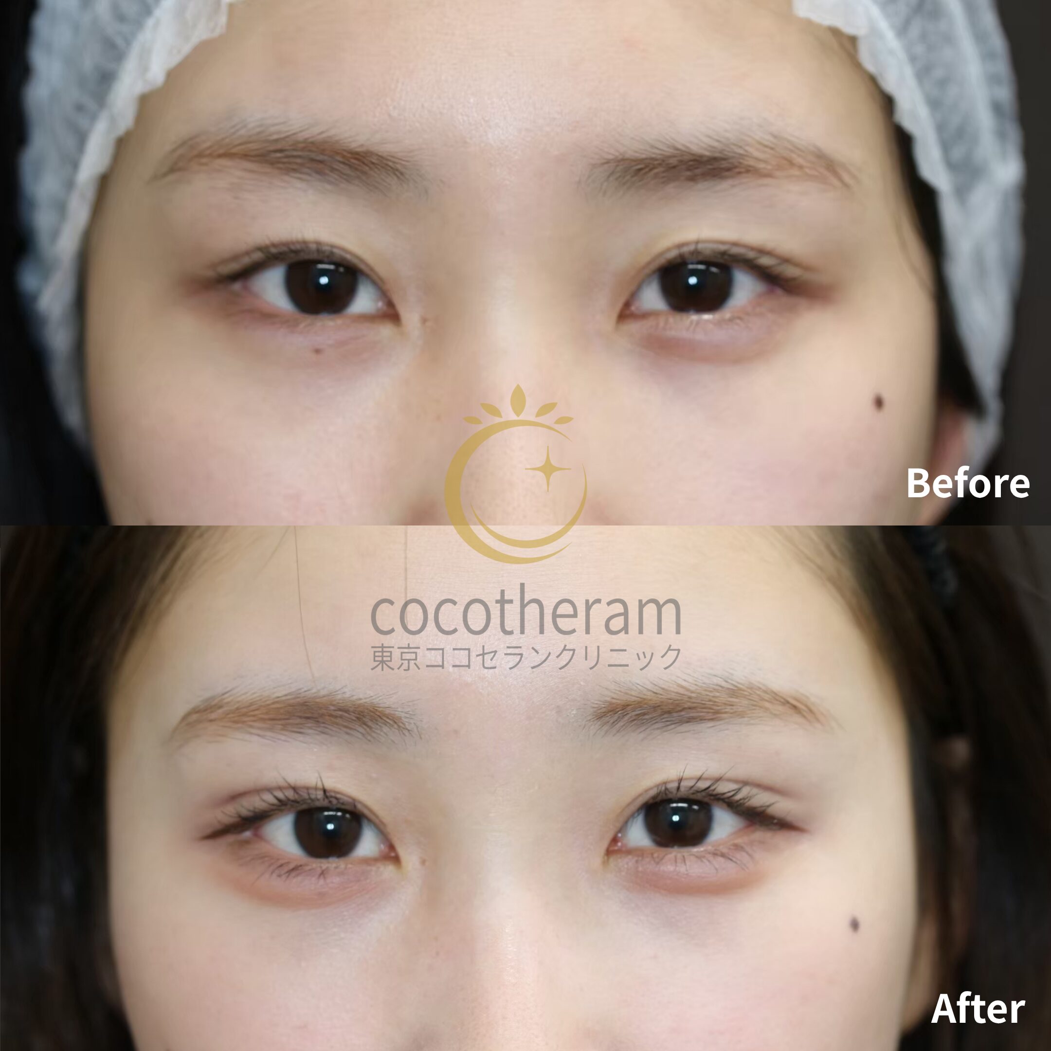 二重埋没法2点留め