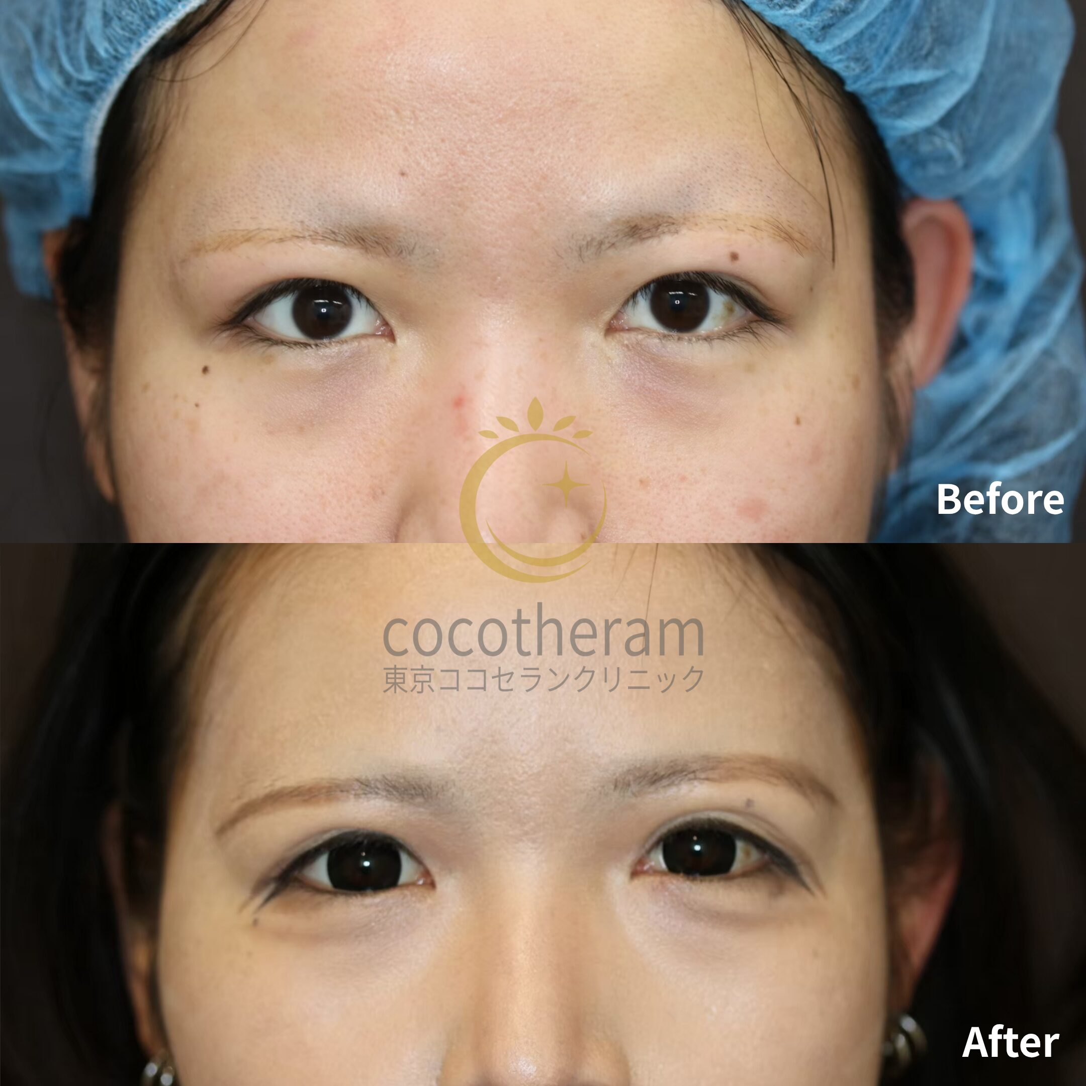 二重埋没法2点留め