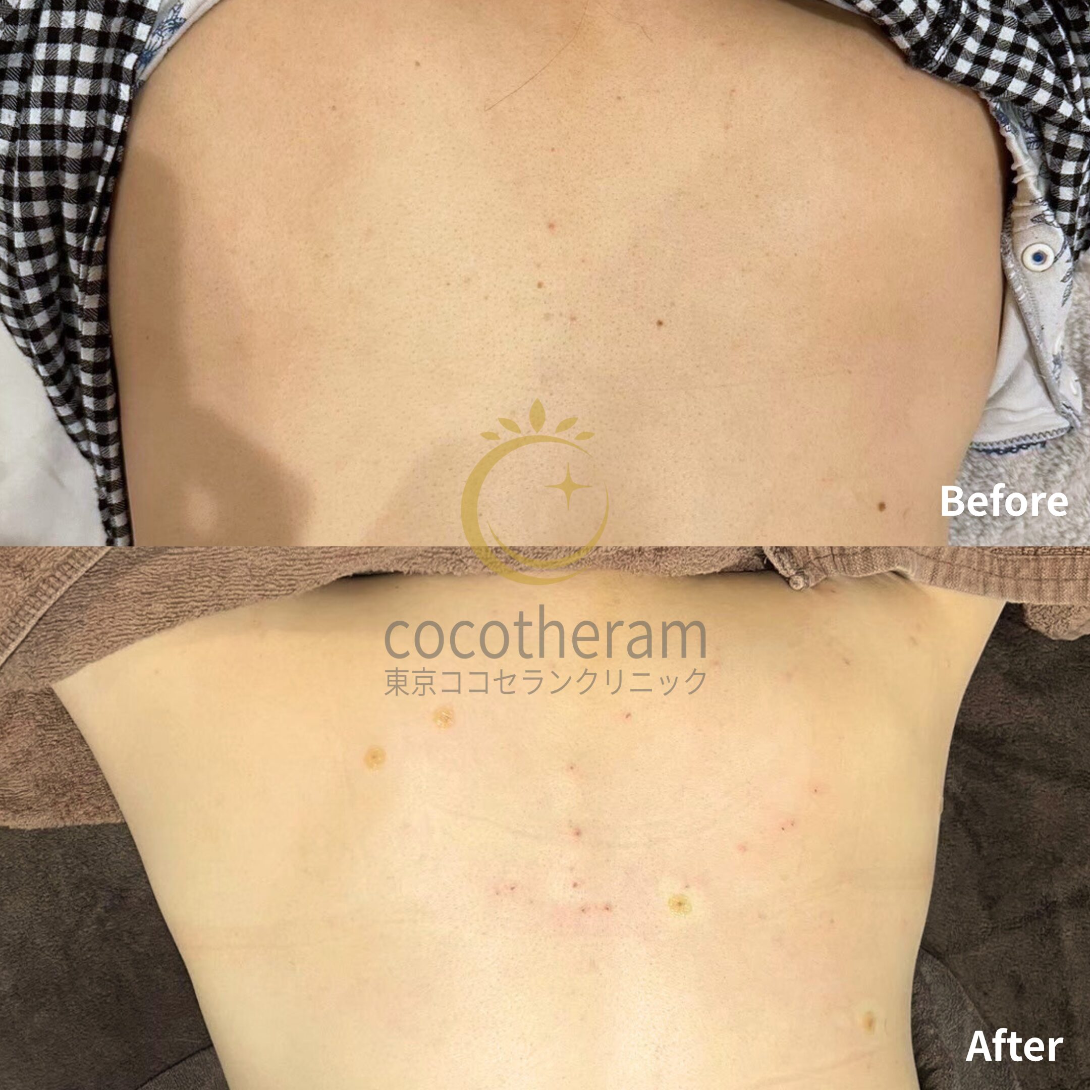 炭酸ガスレーザー / サリチル酸ピーリング