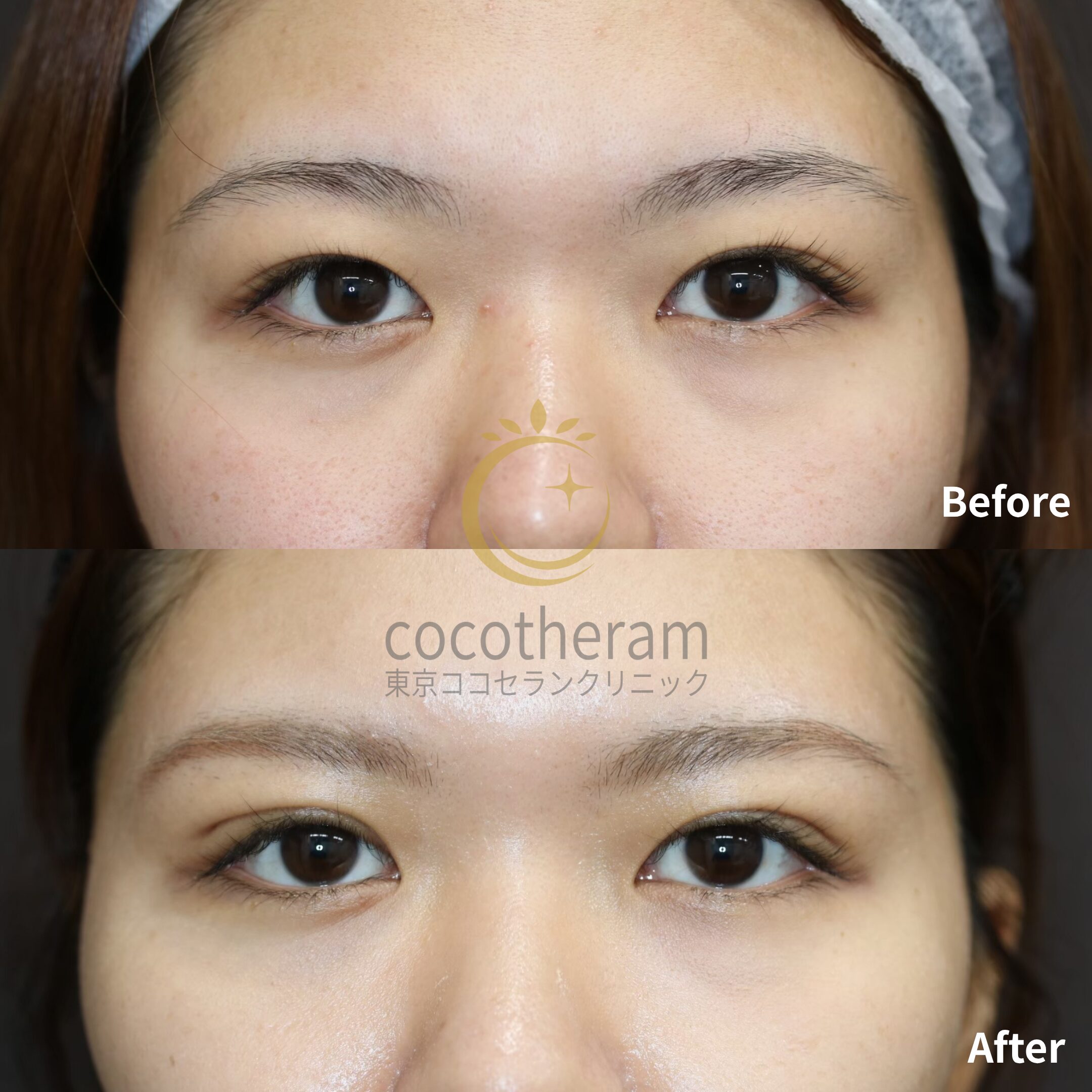 二重埋没法3点留め