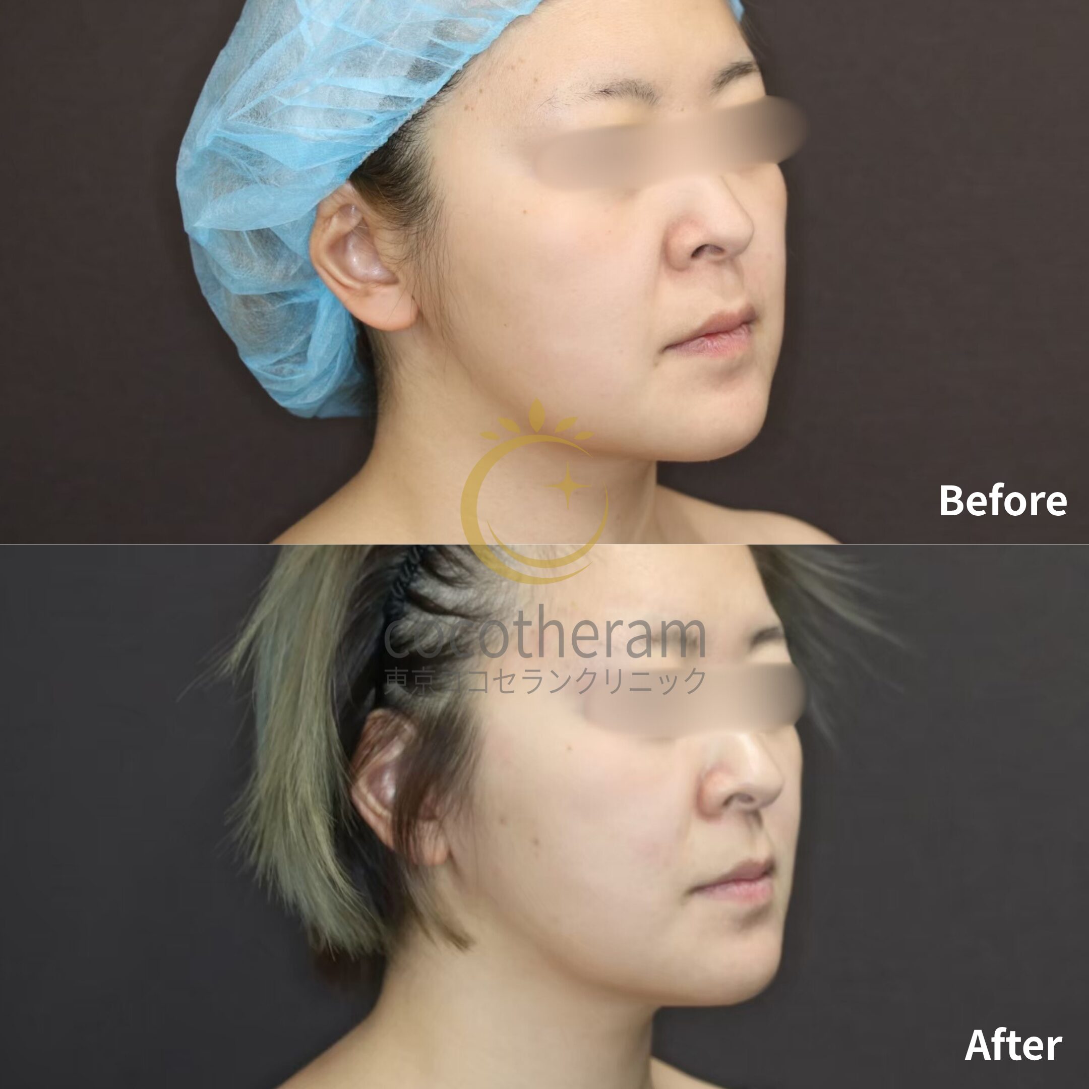 ミニフェイスリフト / 脂肪吸引