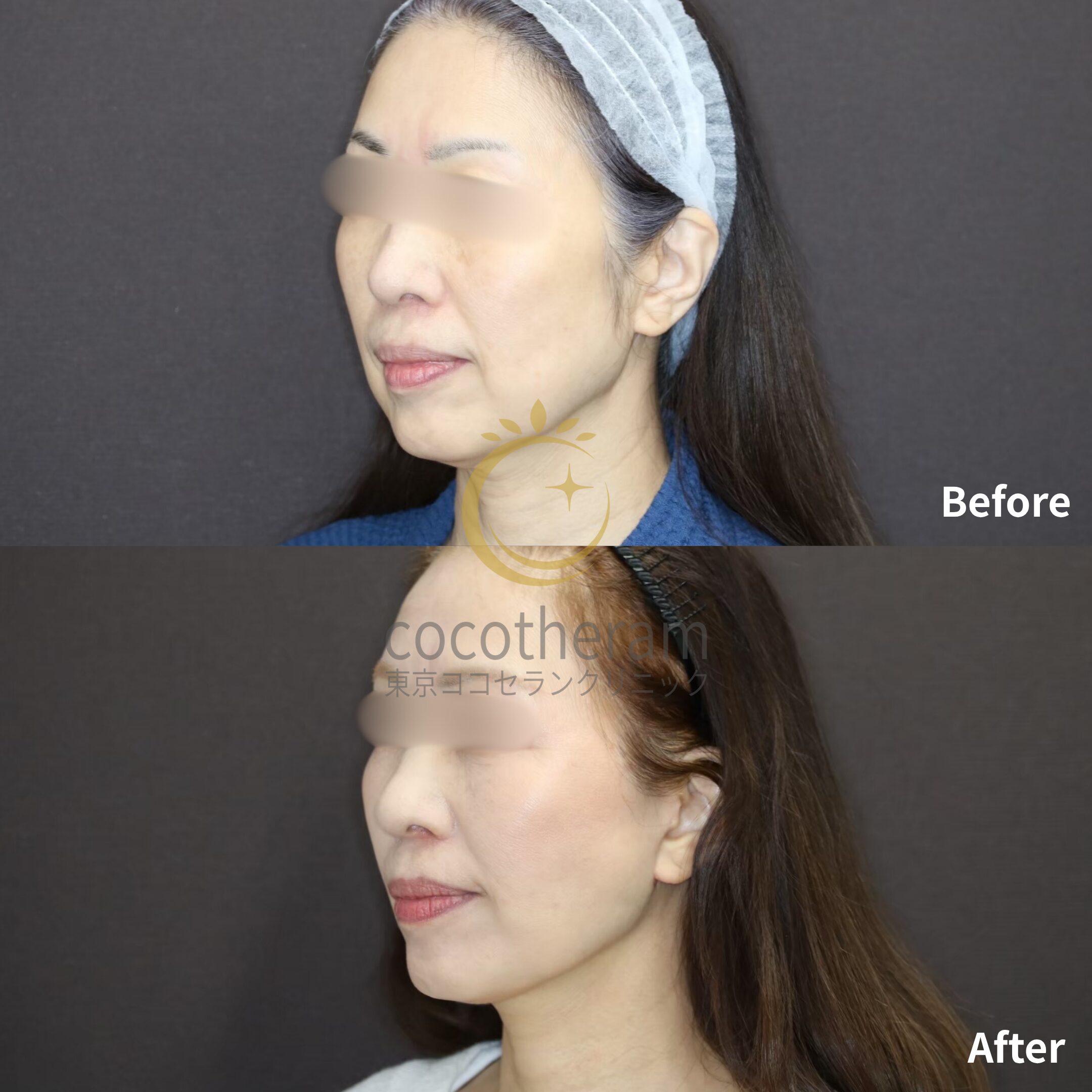 フェイスリフト / 脂肪吸引