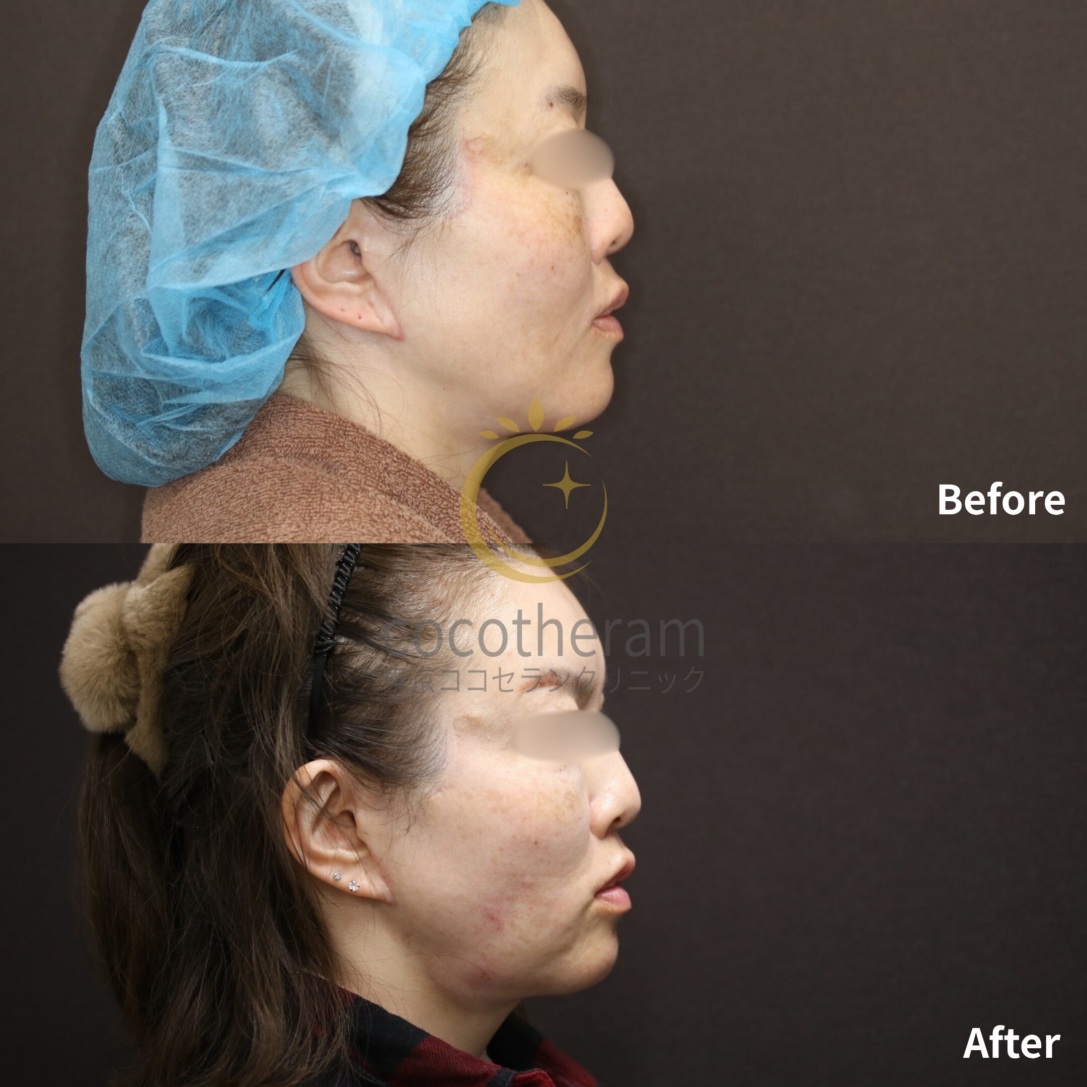 ミッドフェイスリフト