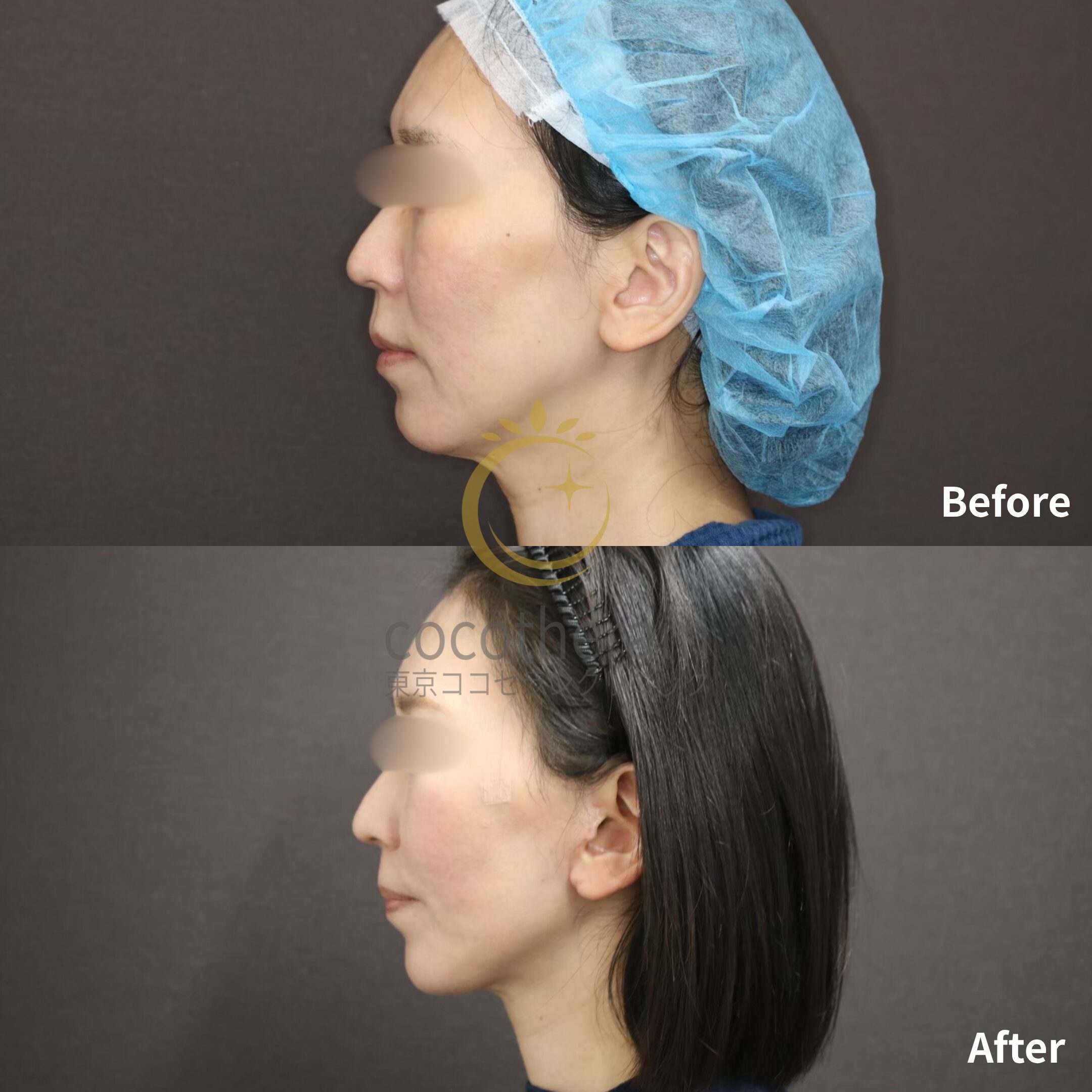 ミッドフェイスリフト / フェイスリフト / 脂肪注入