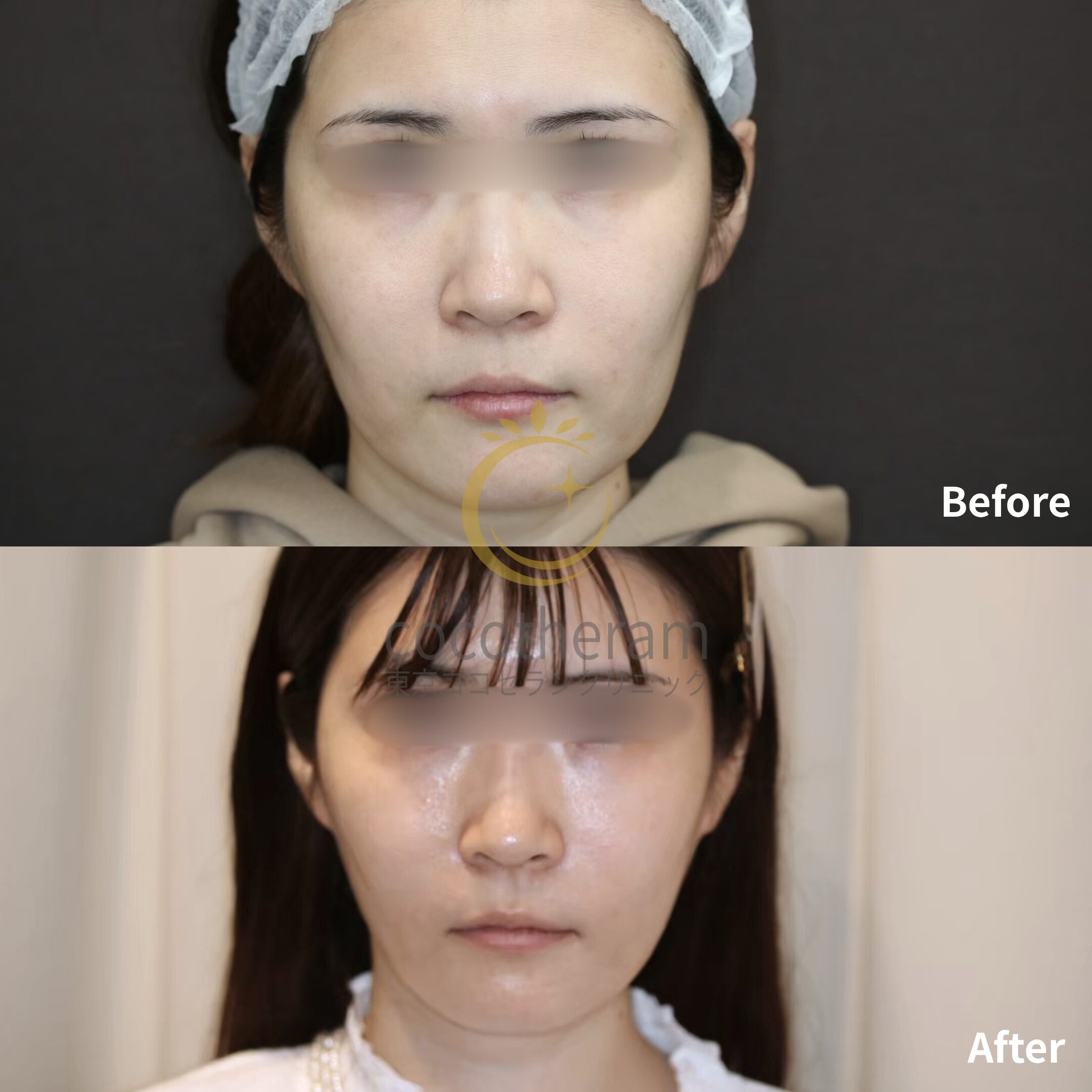 MACsリフト / 脂肪吸引