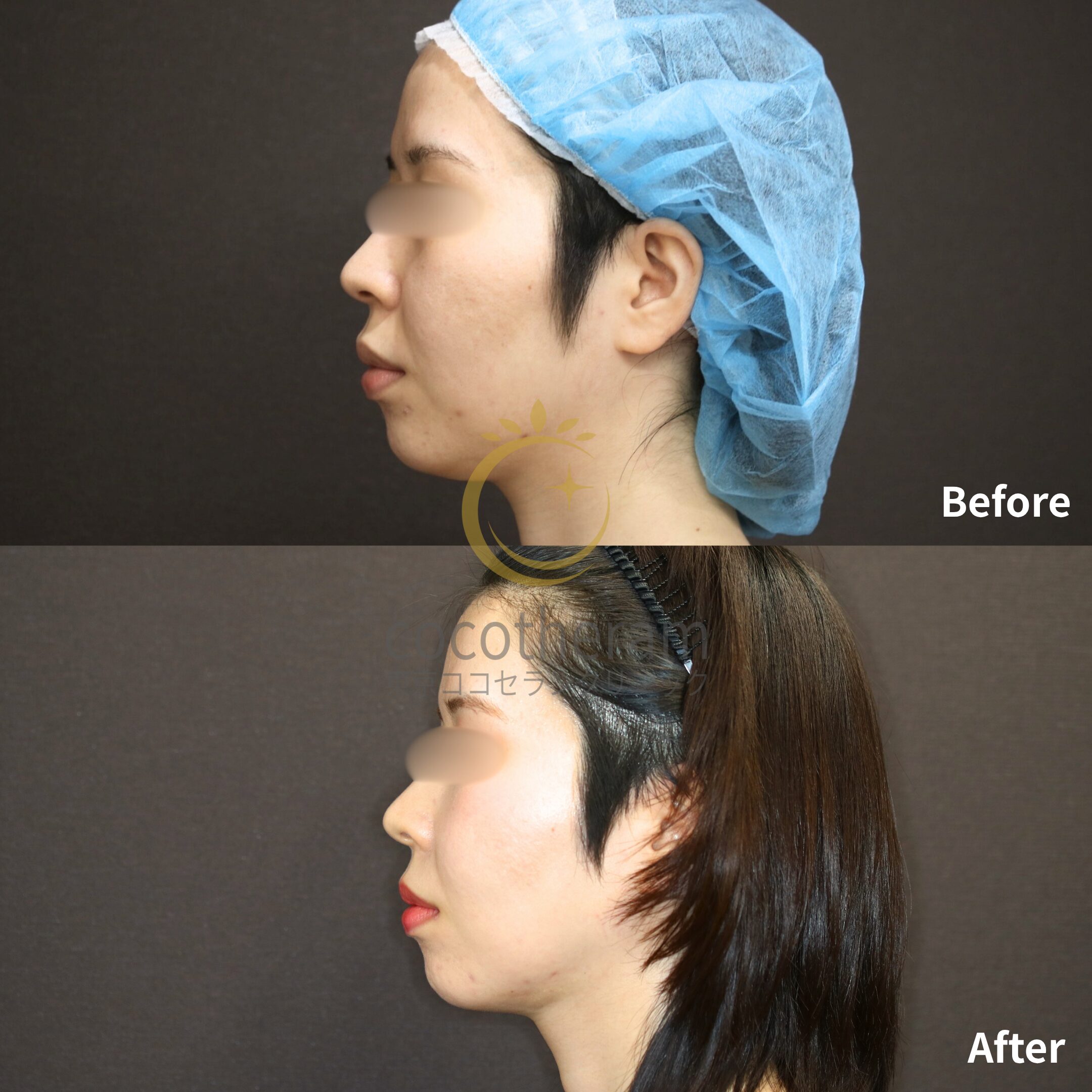 ミッドフェイスリフト