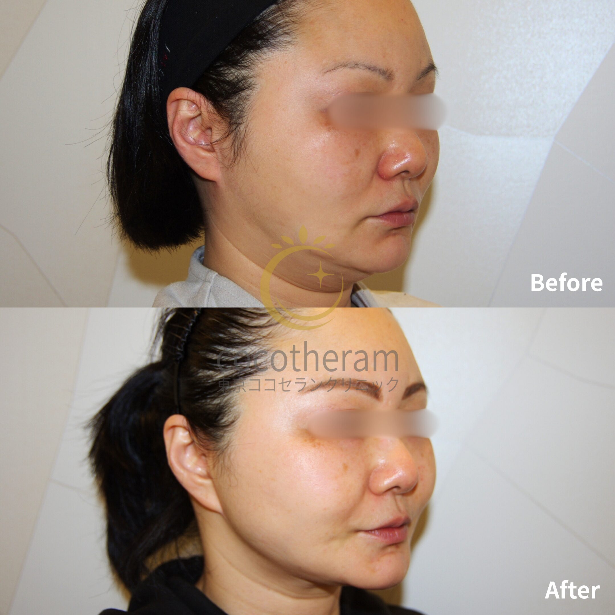 フェイスリフト