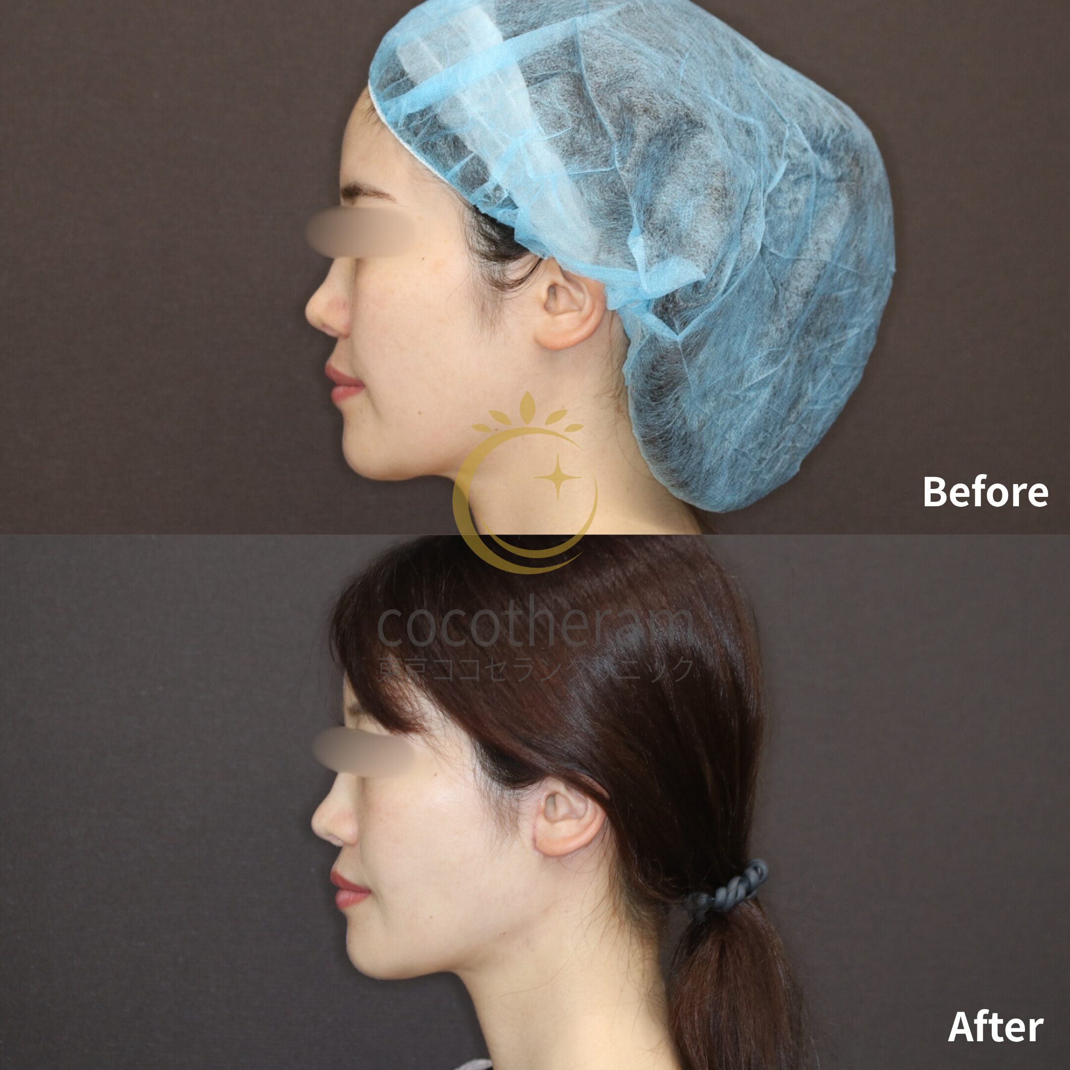 MACsリフト / 脂肪吸引