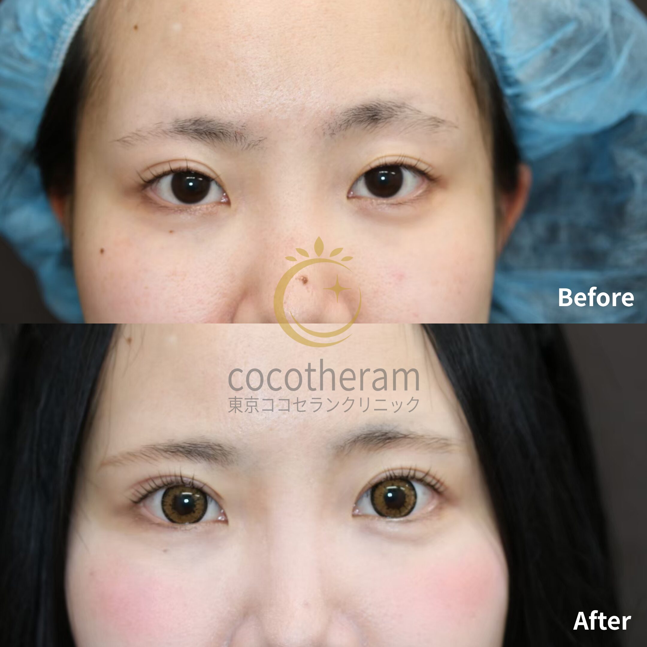 二重切開法 / 二重埋没抜糸法