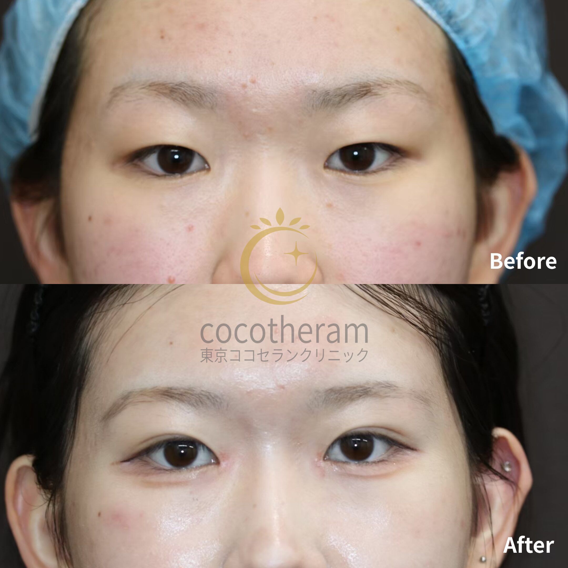 二重埋没法3点留め / 目頭切開