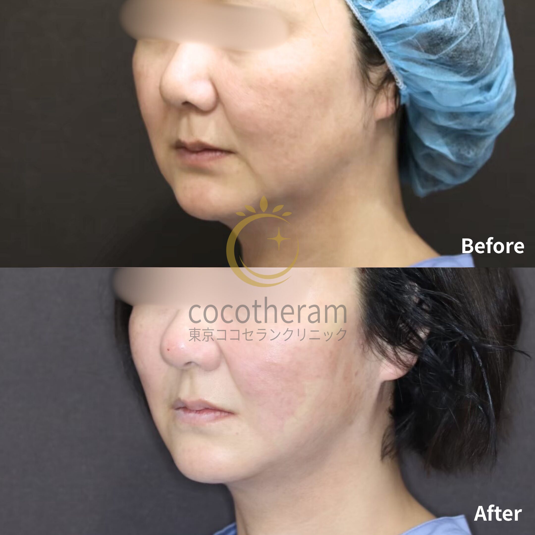 スレッドリフト