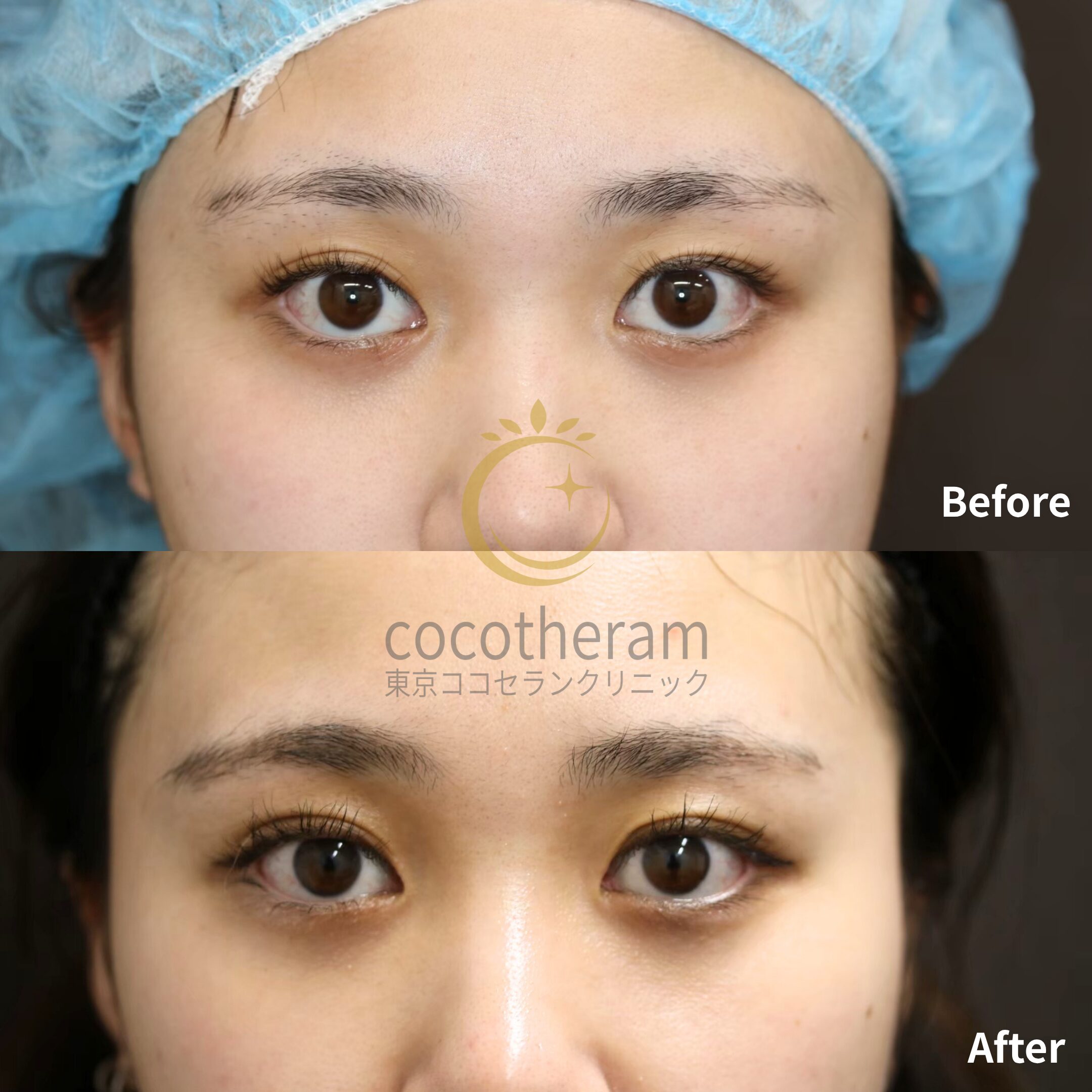 二重埋没法3点留め