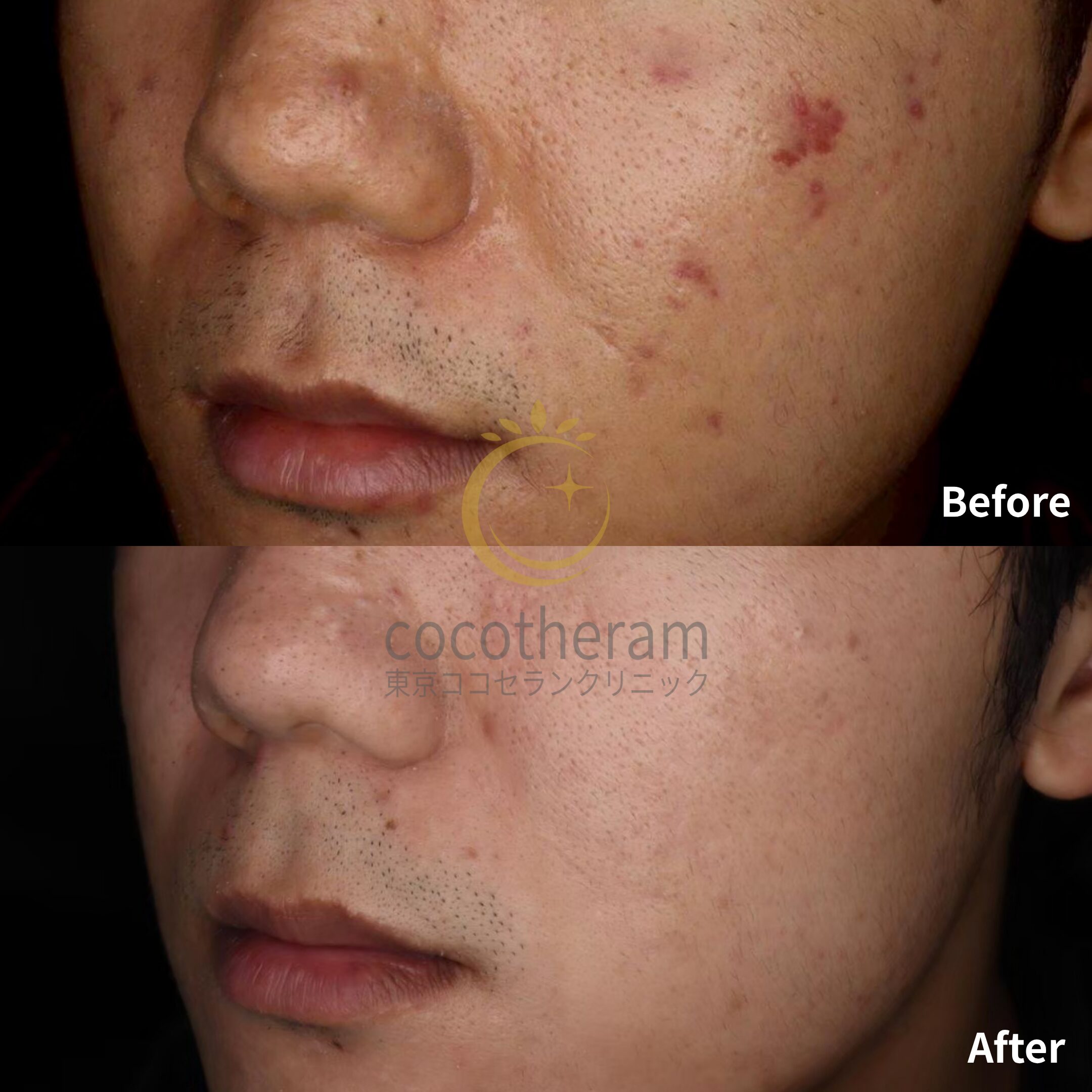 アドバテックスレーザー