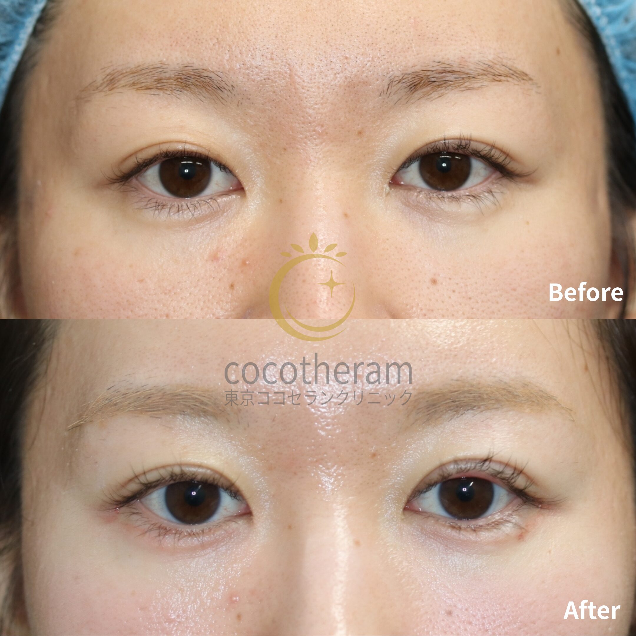 二重切開法 / 二重埋没抜糸法