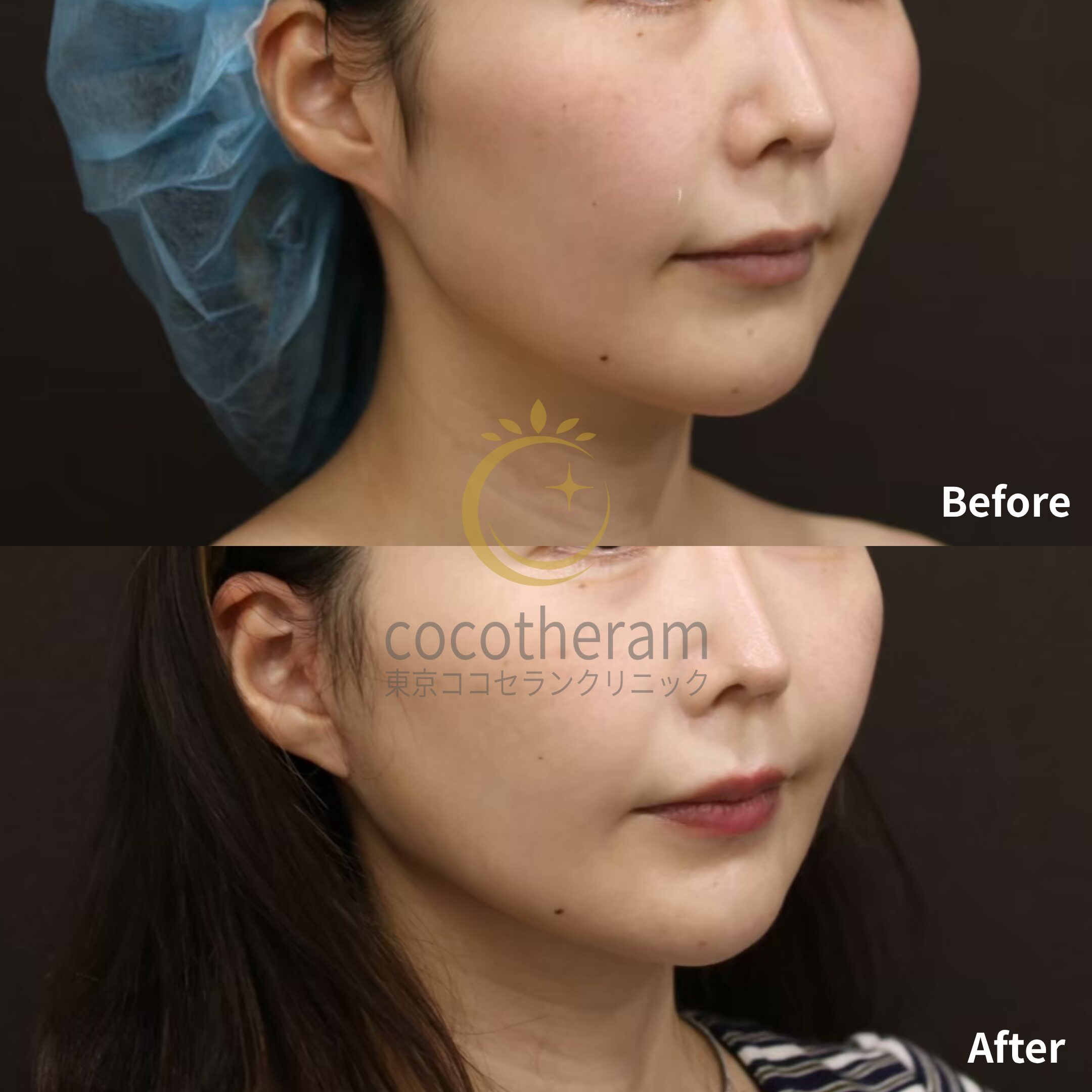 MACsリフト / 脂肪吸引