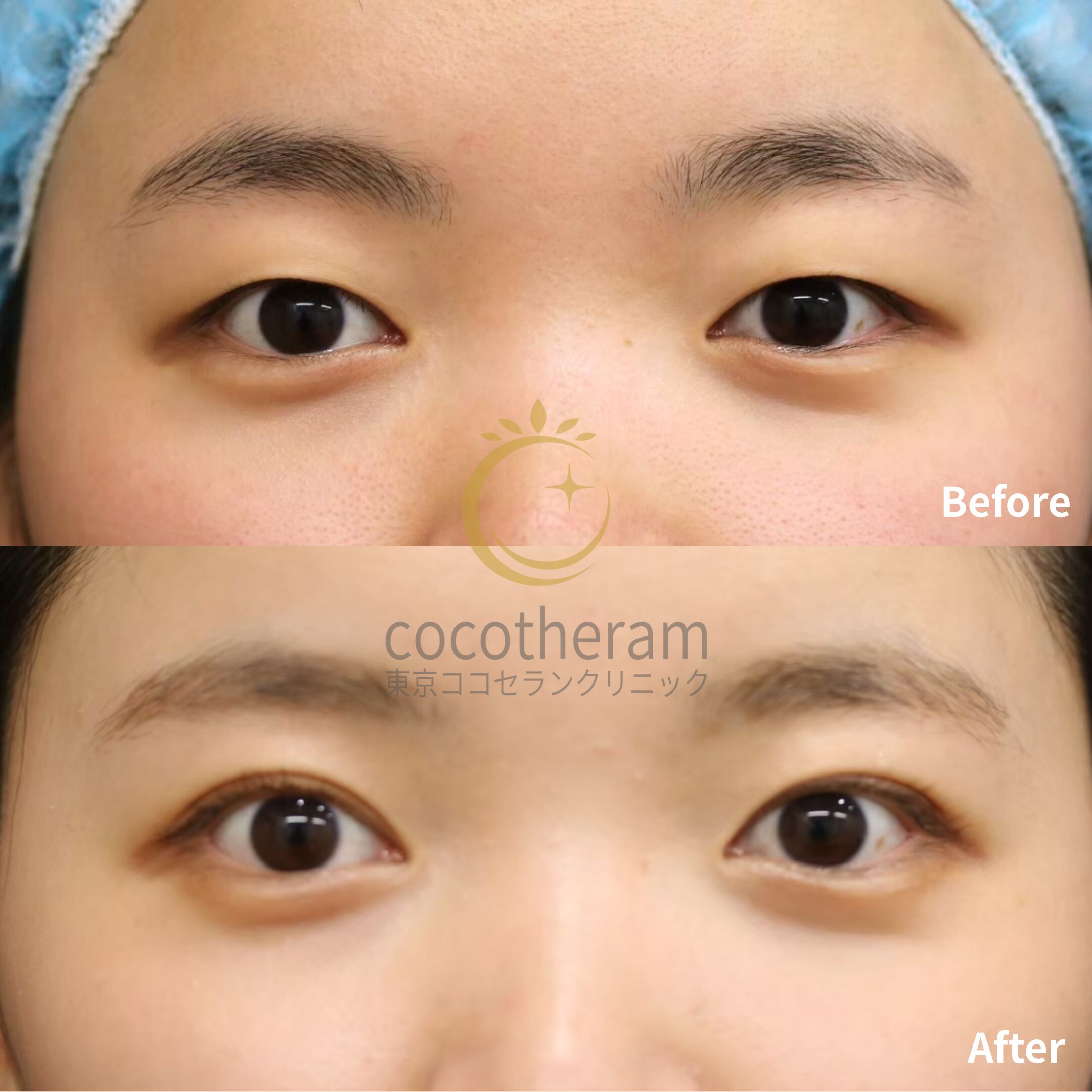 二重埋没法3点留め