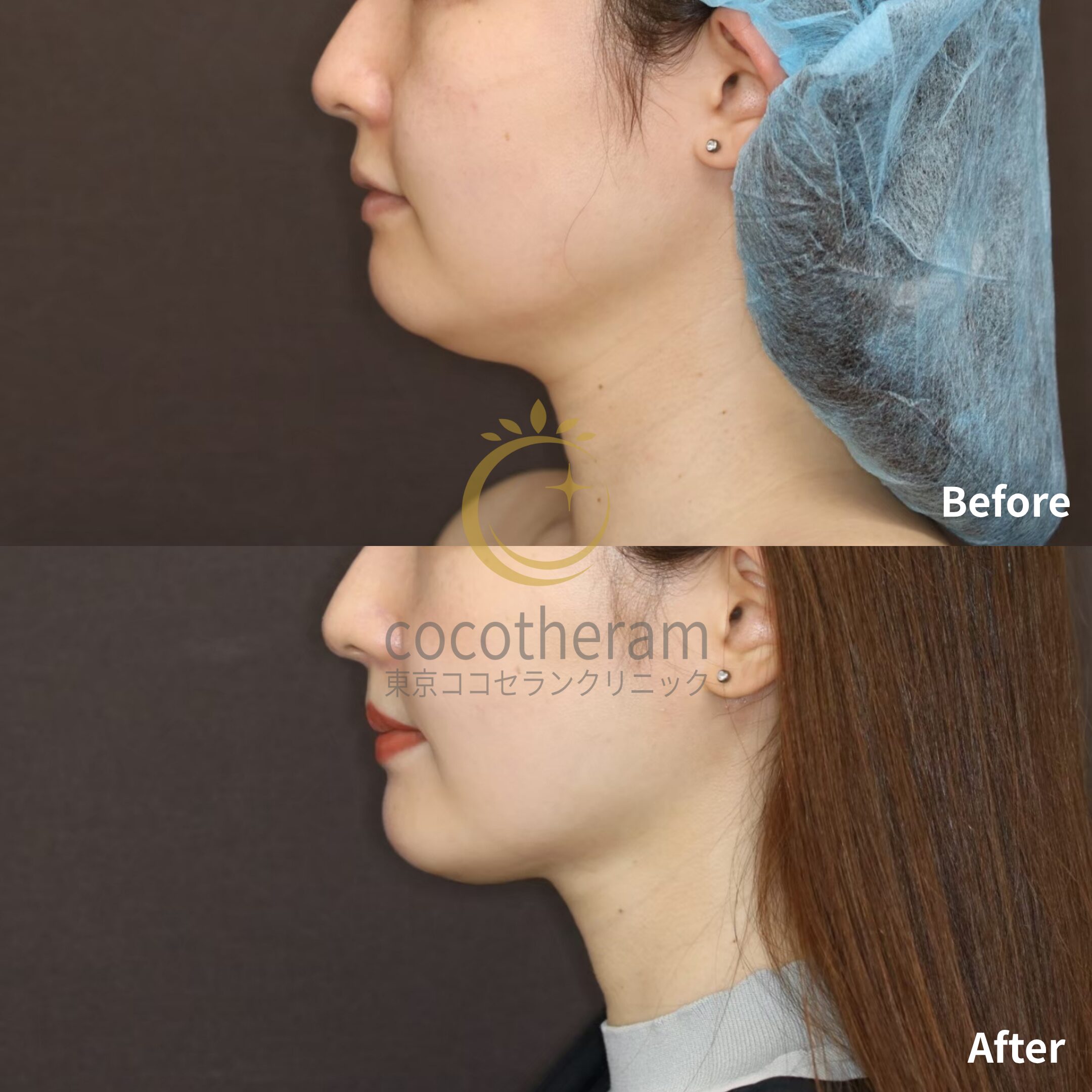 小顔マジック / ボトックス注射