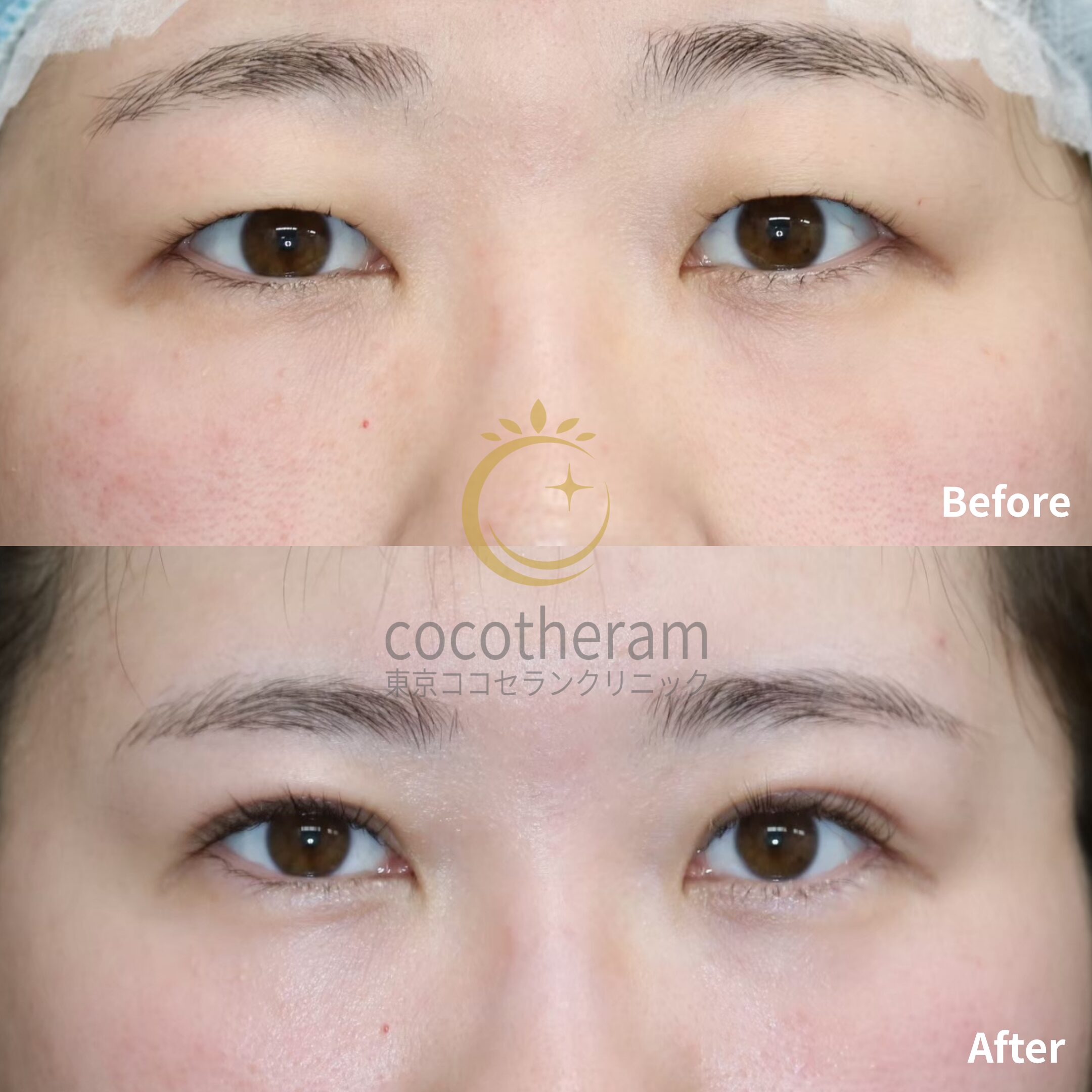 二重埋没法6点留め