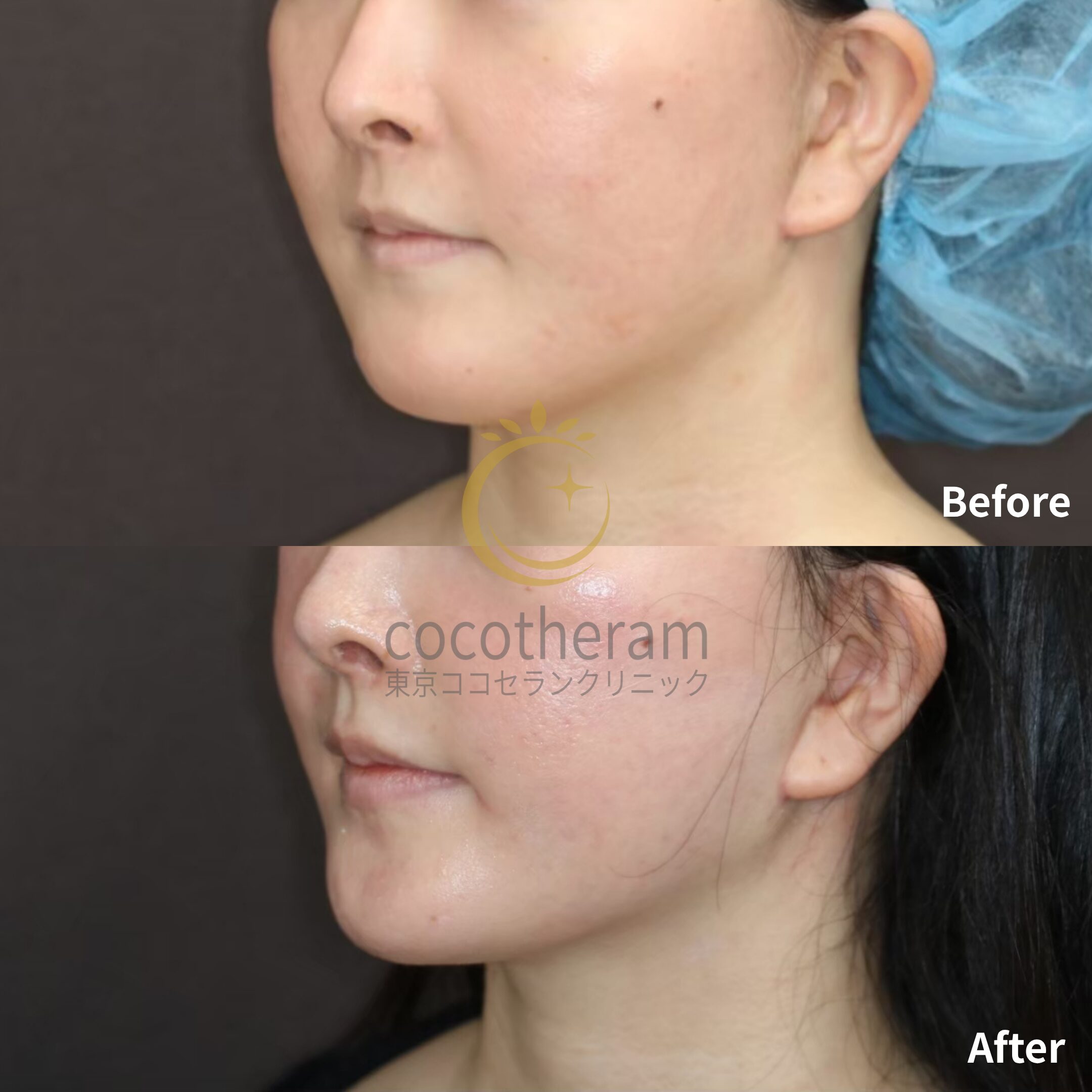 ミッドフェイスリフト