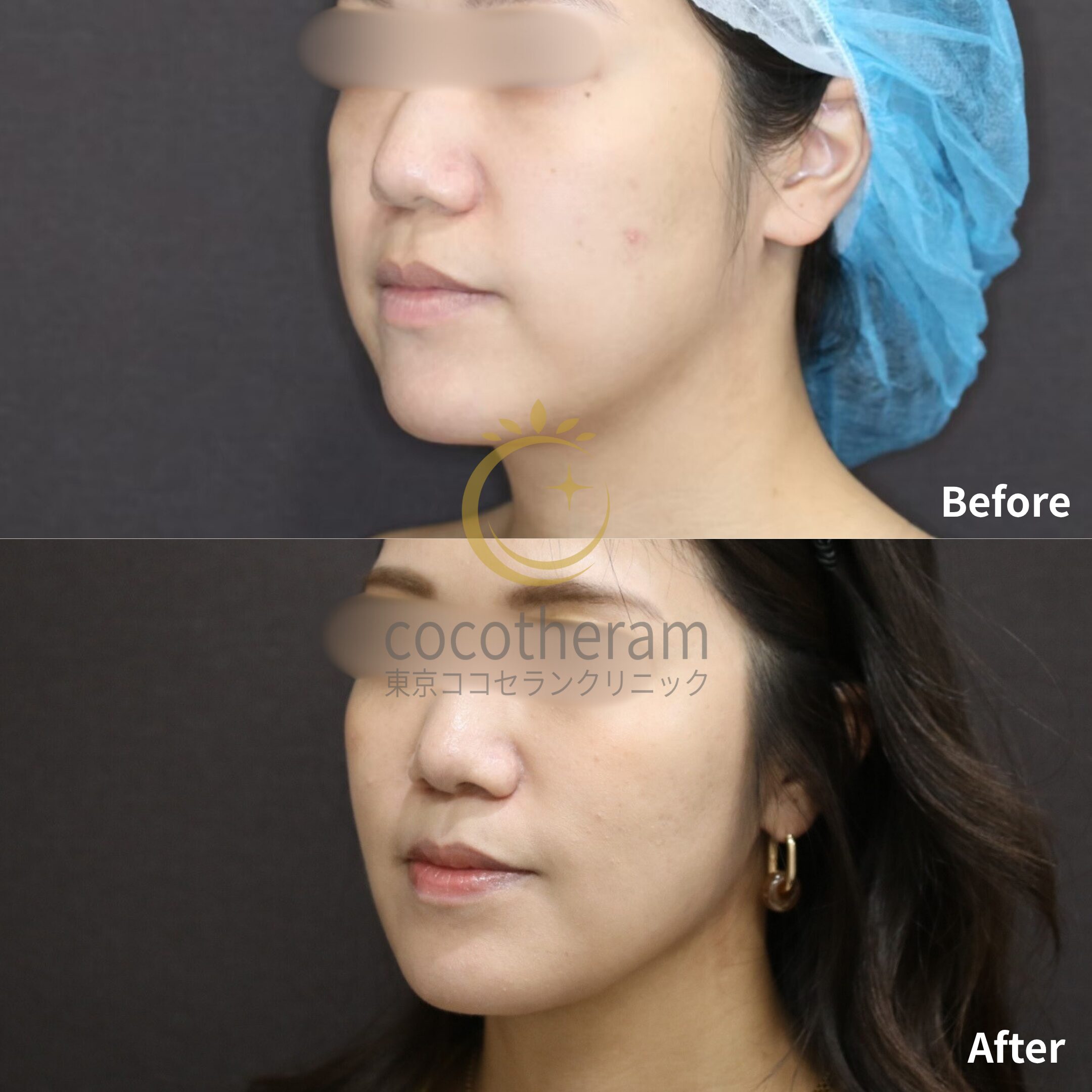 小顔マジック / 脂肪注入 / ボトックス注射