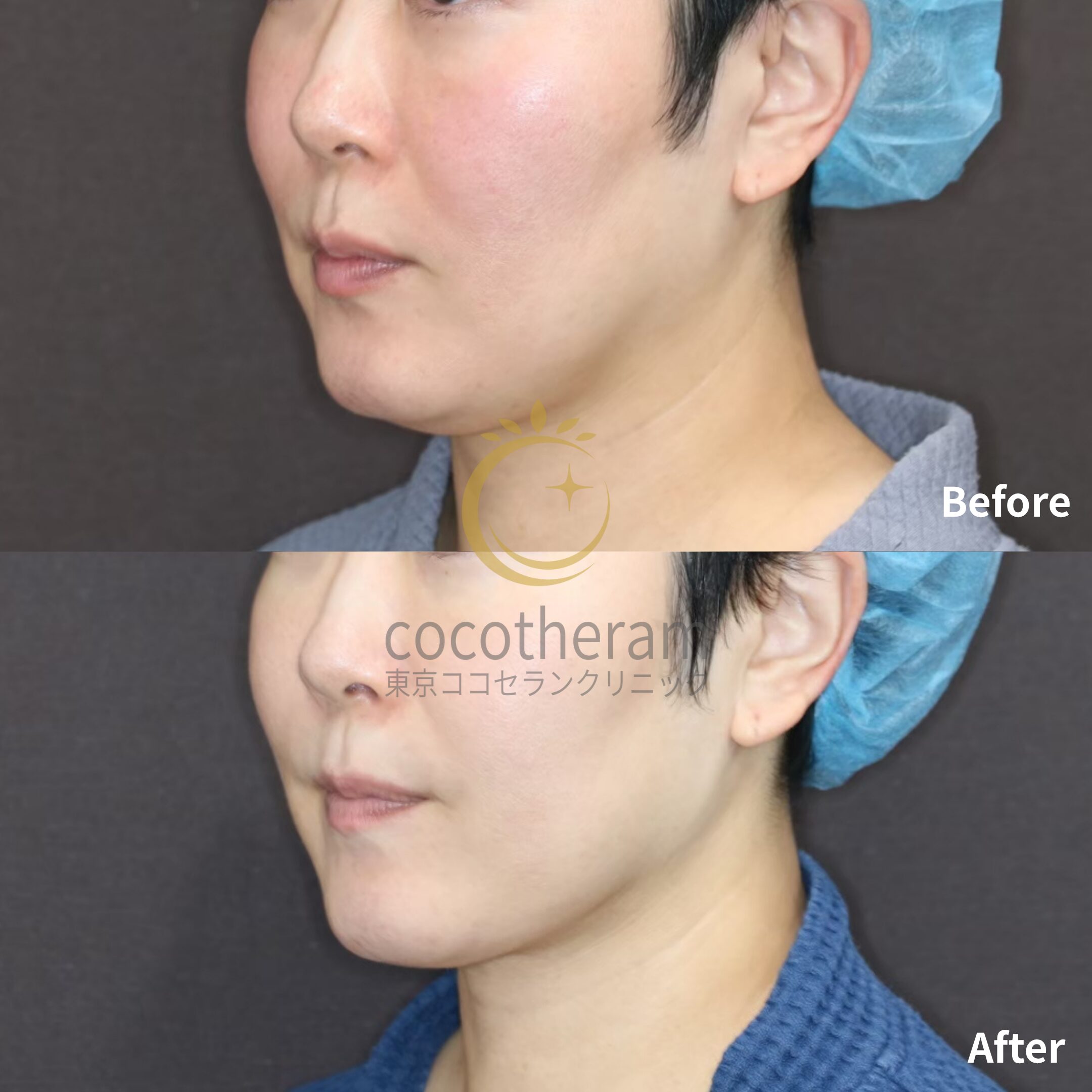 アンカーDXダブル / ボトックス注射