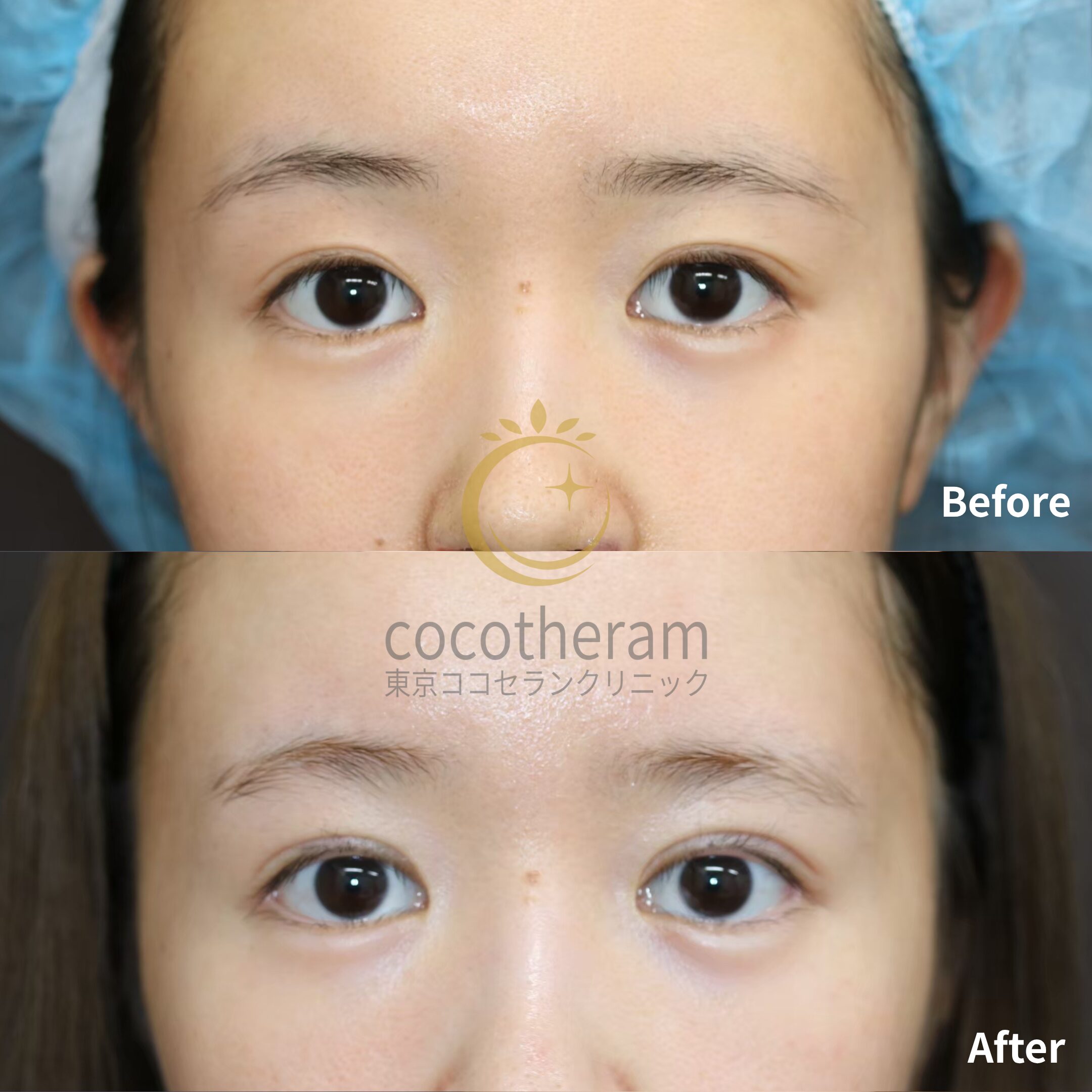 二重切開法 / 二重埋没抜糸法 / 目尻切開 / グラマラスライン形成