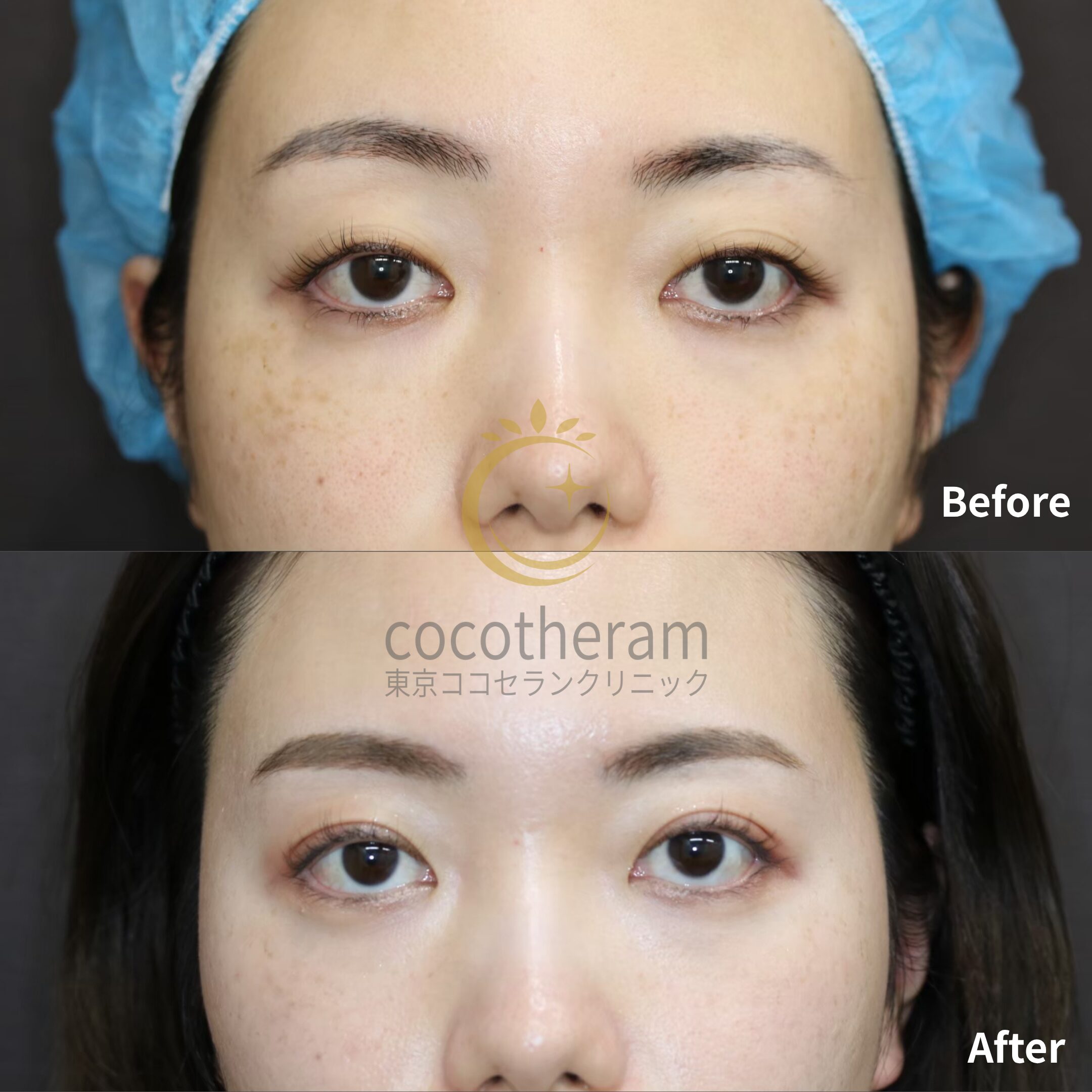 二重埋没法3点留め